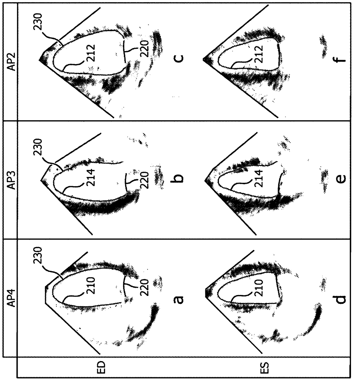 Ultrasonic cardiac assessment of hearts with medial axis curvature and transverse eccentricity