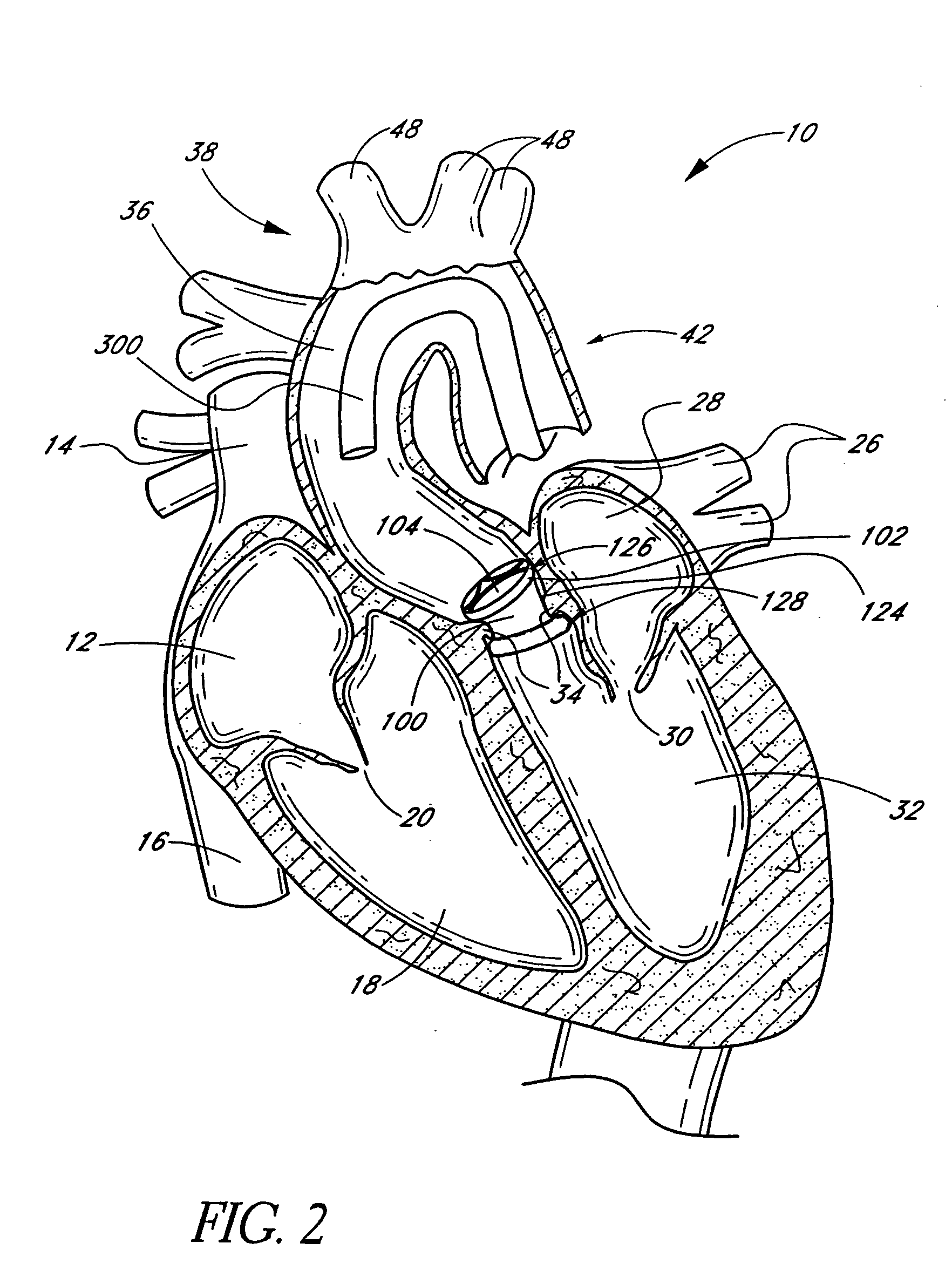 Translumenally implantable heart valve with formed in place support