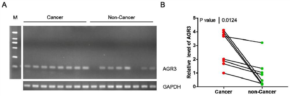 Gastric cancer tumor marker and application thereof