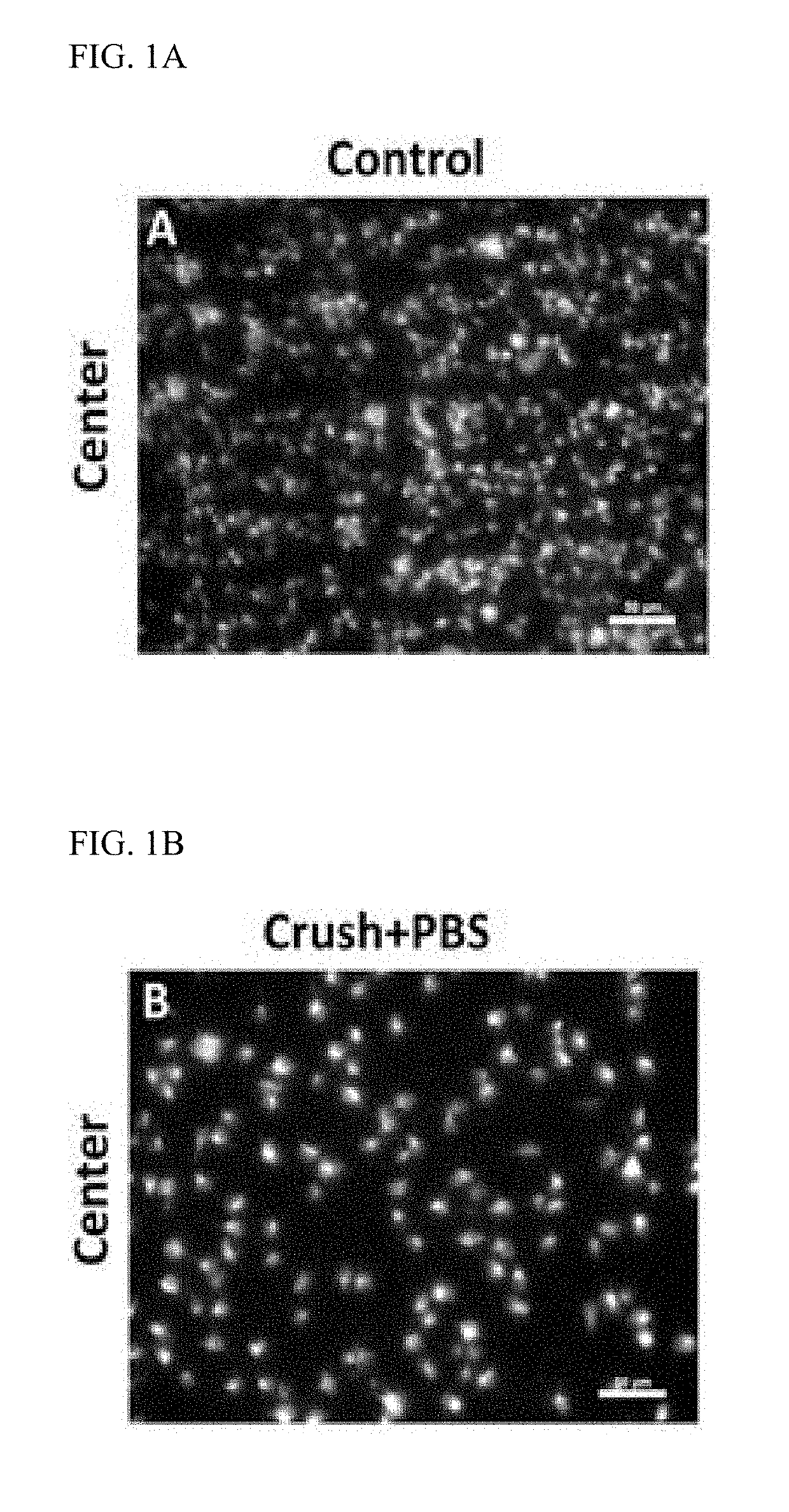 Method of treating, reducing, preventing deterioration or improving visual function after optic neuropathy