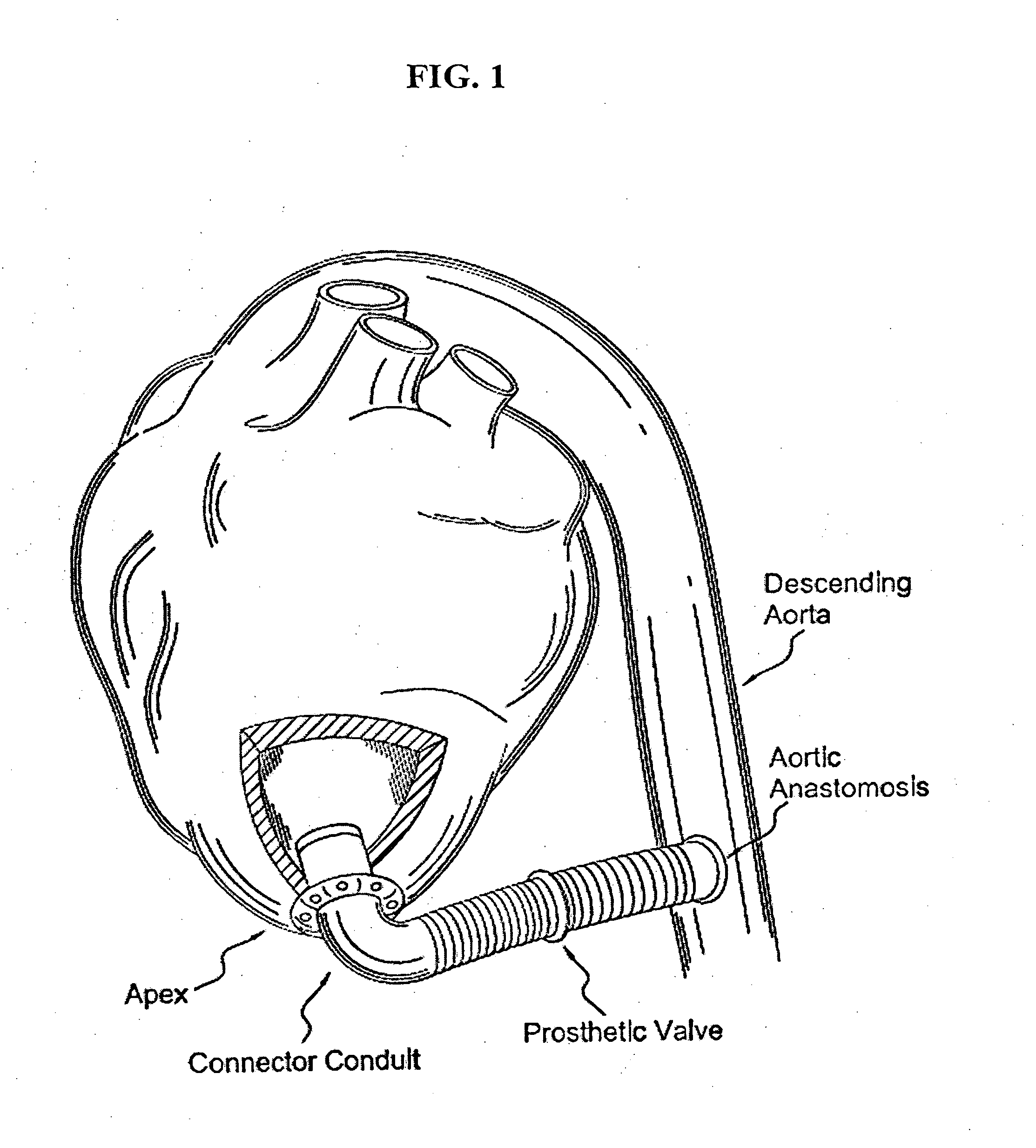 Apparatus and method for forming a hole in a hollow organ