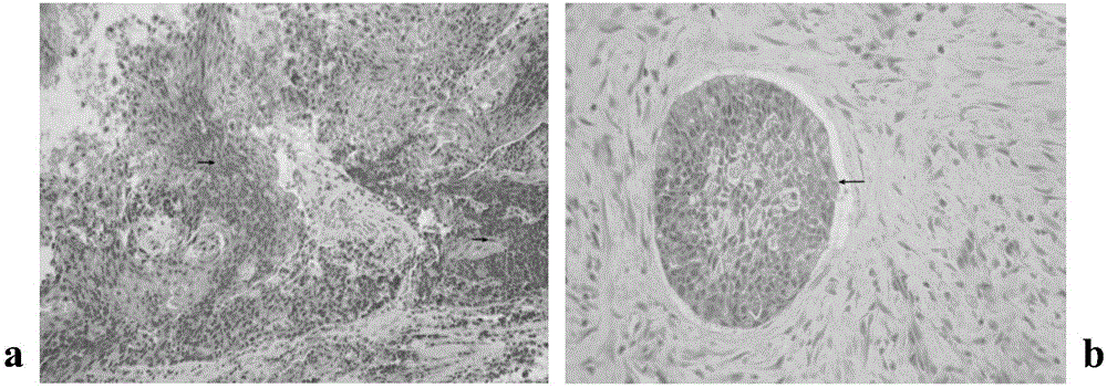 LAMP primer group CK19-115 for quickly detecting lymphatic metastasis of head and neck squamous cell carcinoma