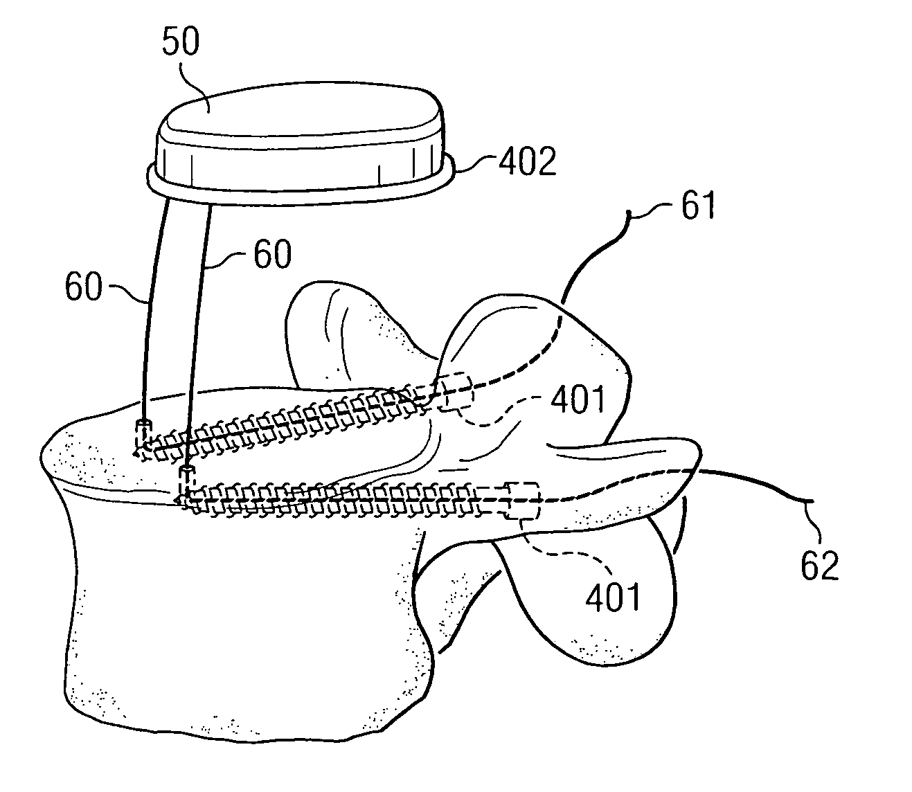 Nucleus replacement securing device and method