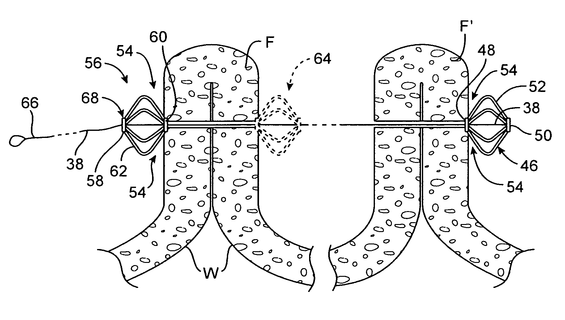 Apparatus and methods for optimizing anchoring force