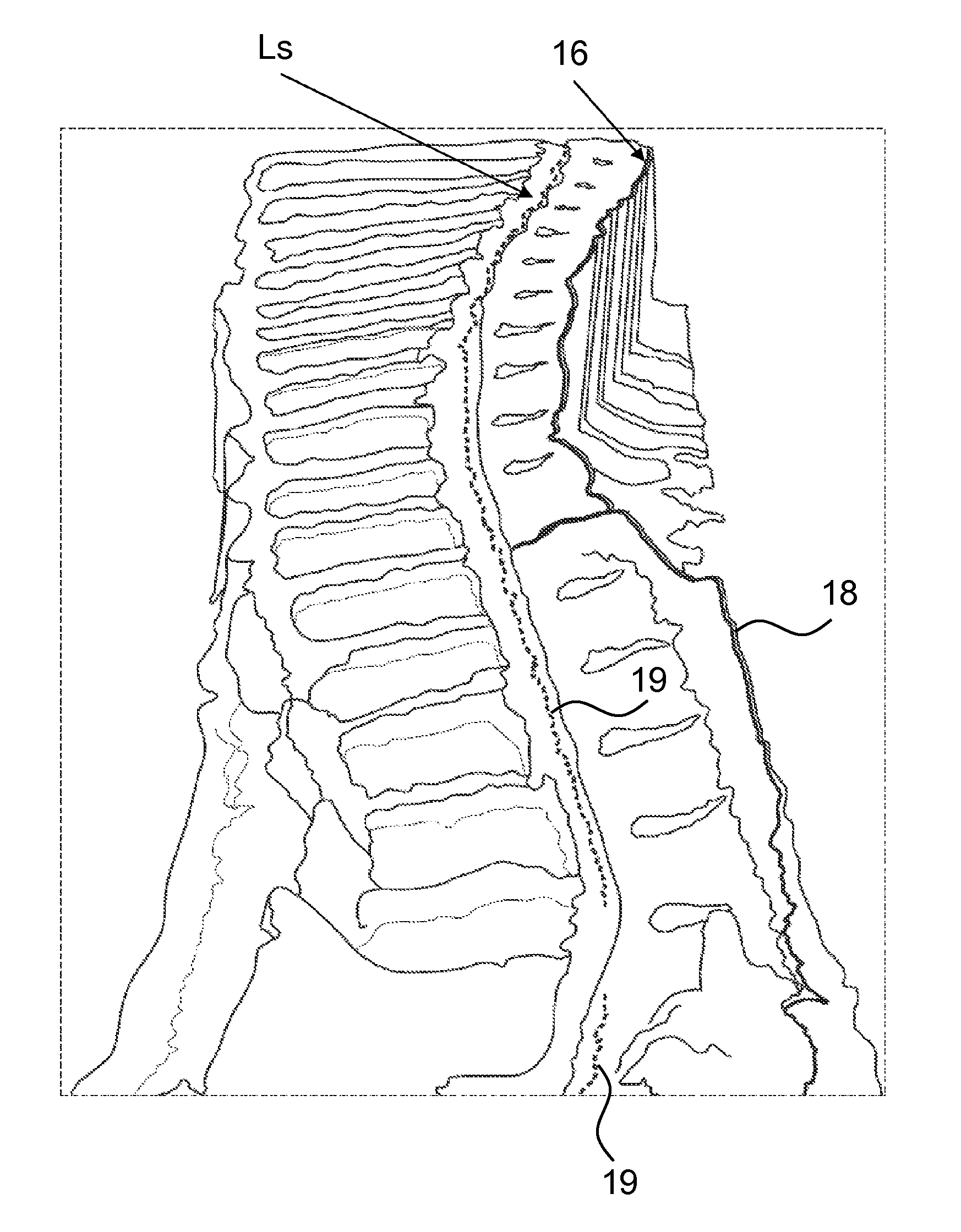 Separation of the spinal column from a carcass middle part