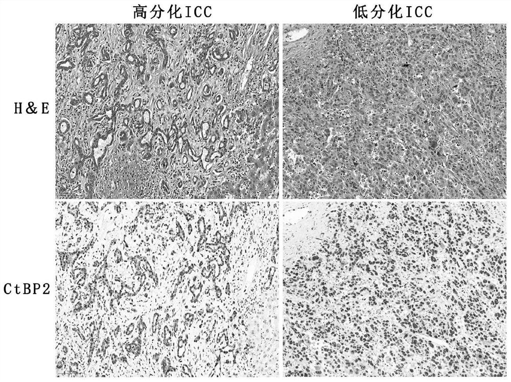 Application of ctbp2 in the preparation of diagnostic products for hepatocellular carcinoma and intrahepatic cholangiocarcinoma