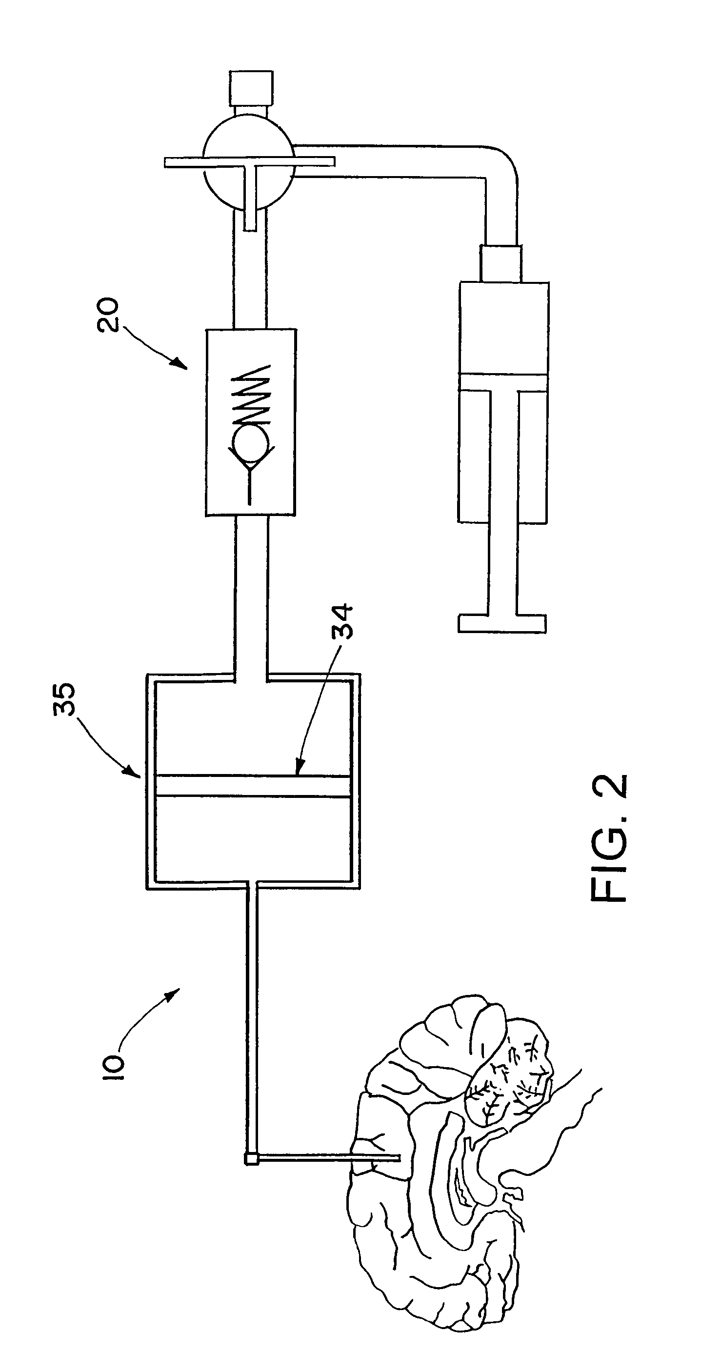 Drug supply system for CED (convection-enhanced delivery) catheter infusions