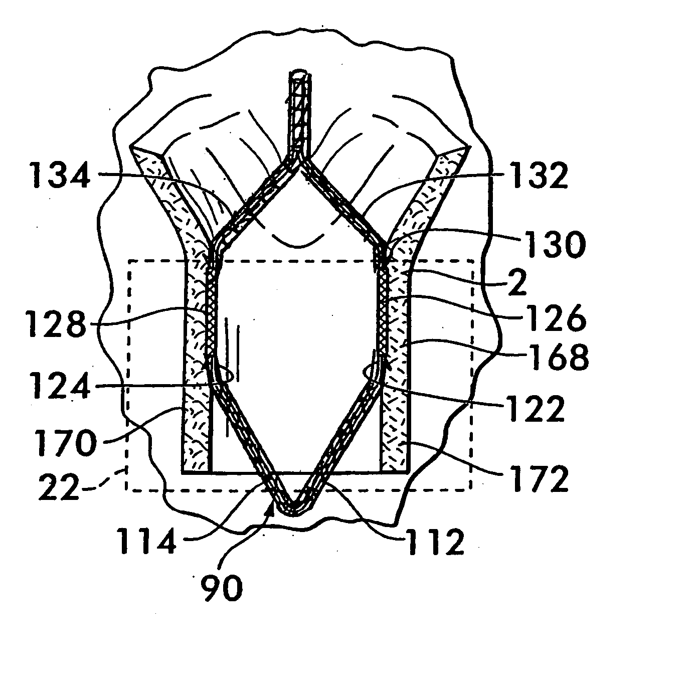 Tissue distention device and related methods for therapeutic intervention