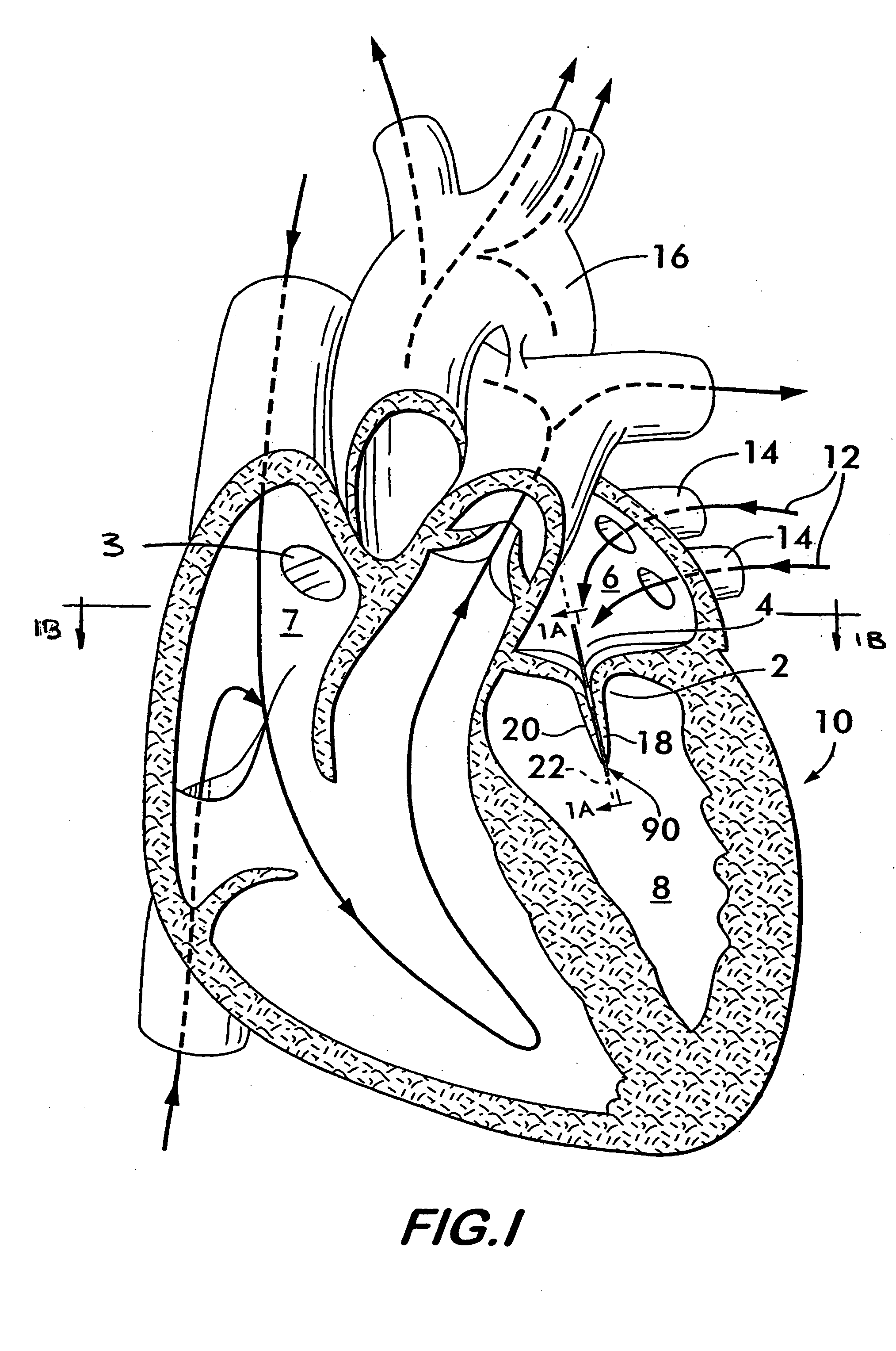 Tissue distention device and related methods for therapeutic intervention