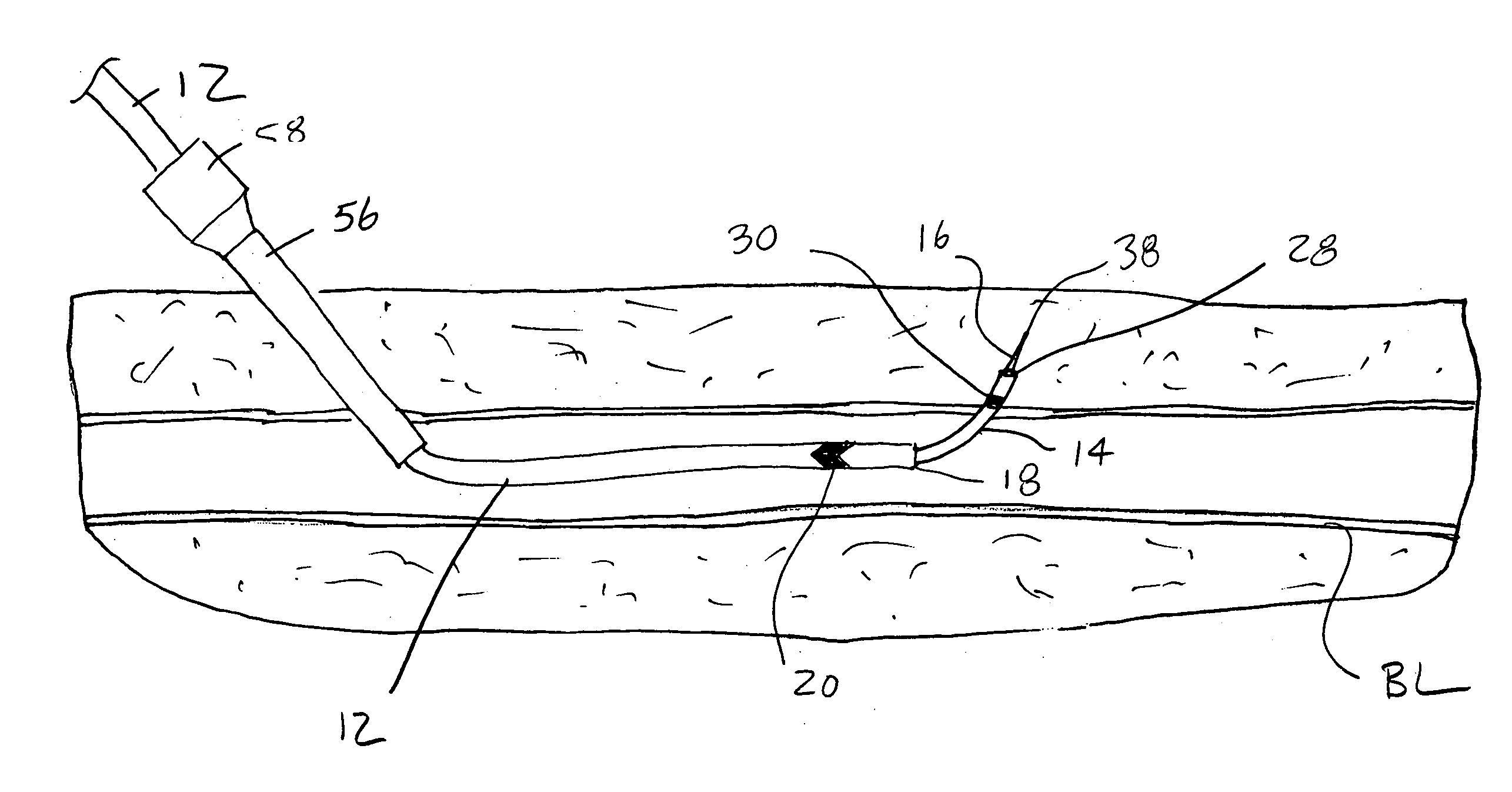 Methods and apparatus for accessing and treating body lumens