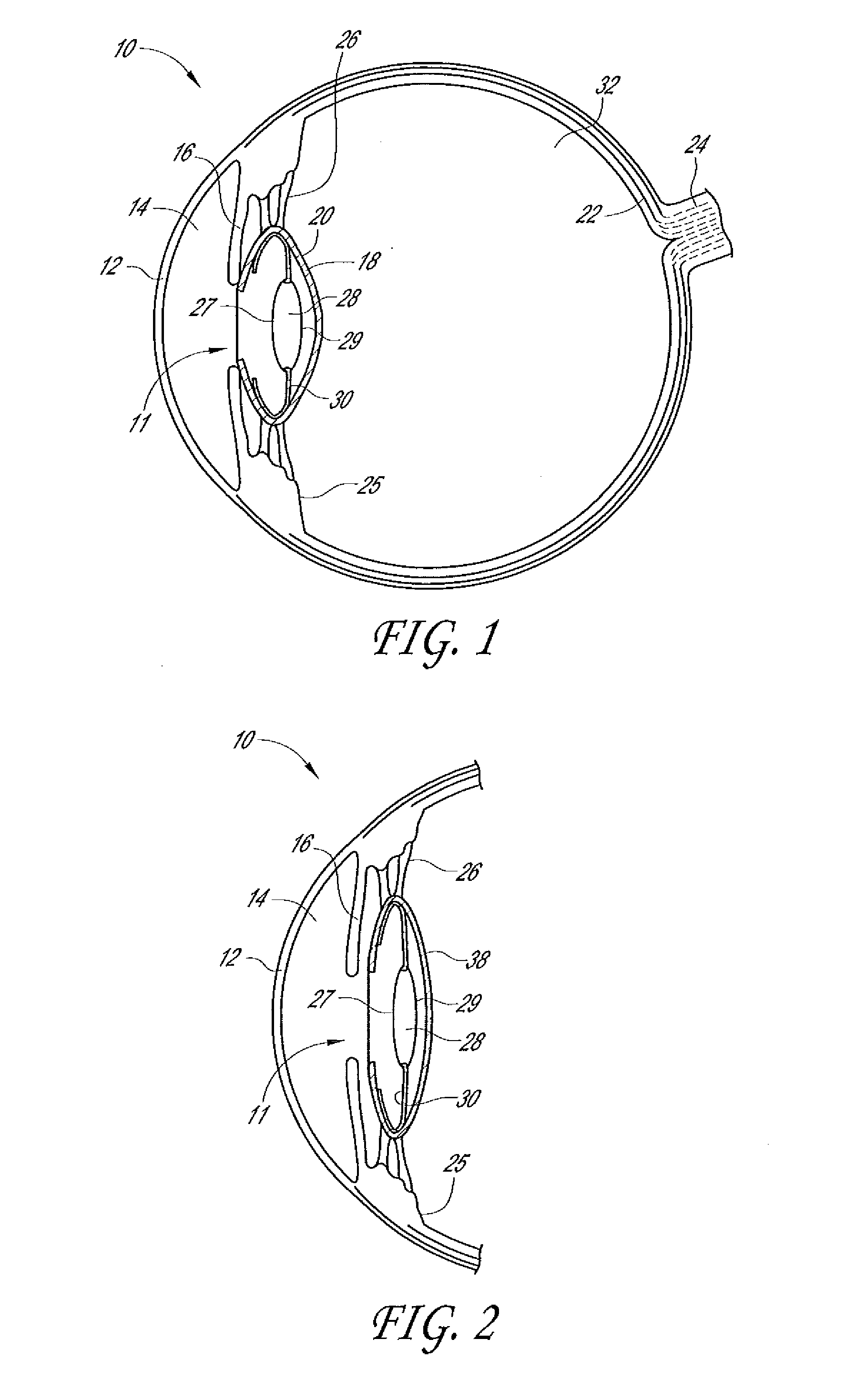 Intraocular lens with shape changing capability to provide enhanced accomodation and visual acuity