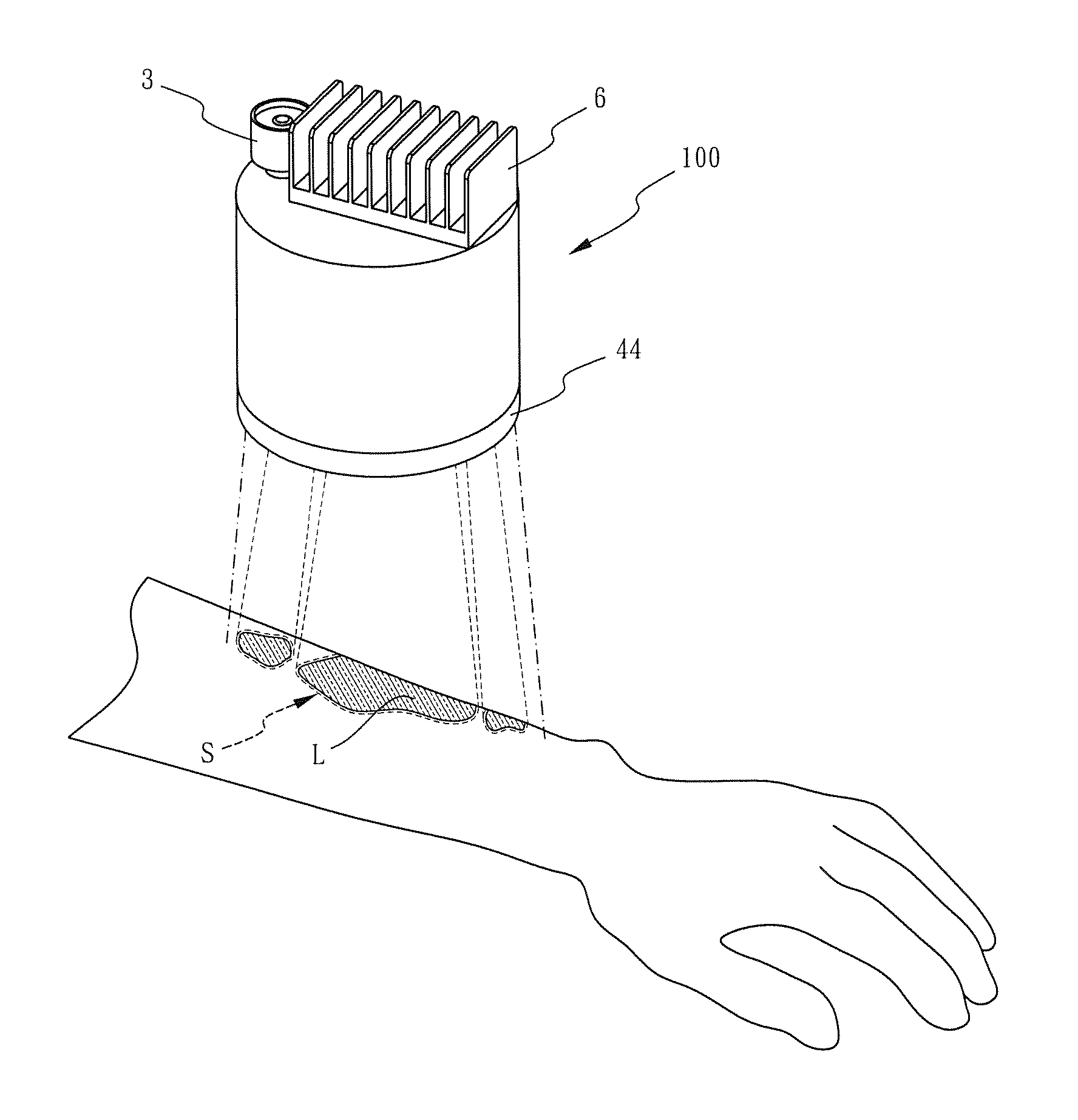 Portable phototherapy apparatus for psoriasis