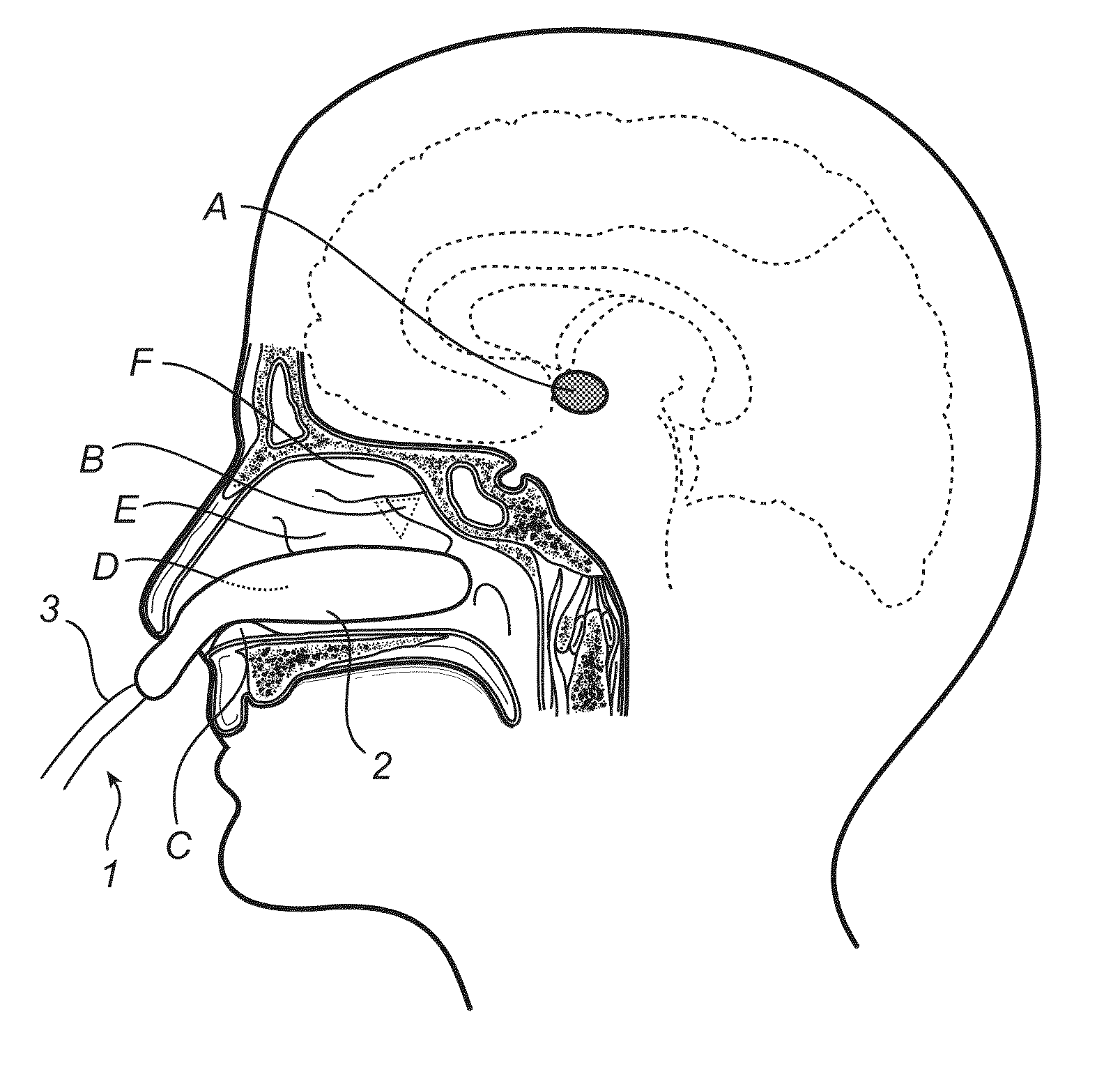 Treatment of headache disorders