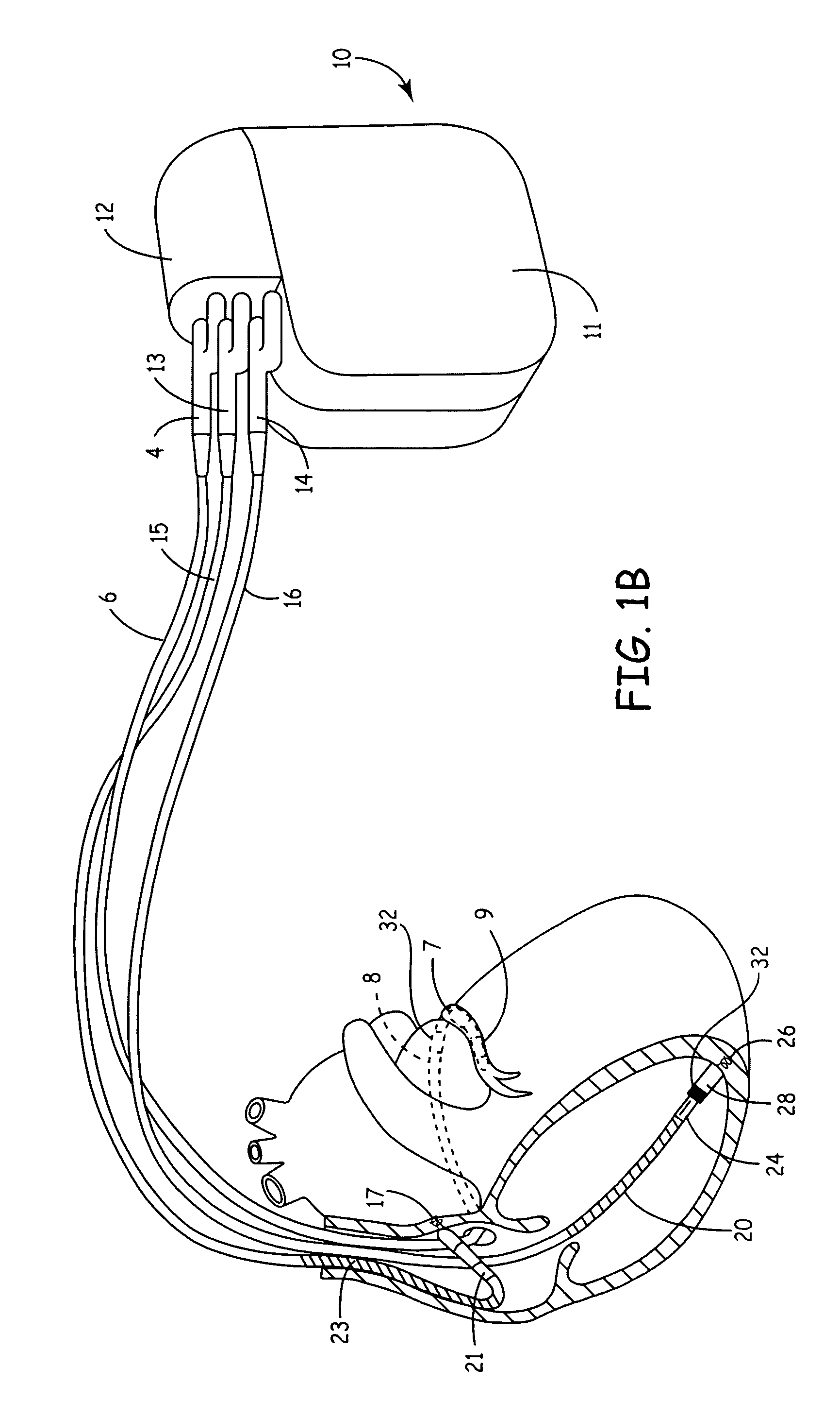 Method and apparatus for controlling extra-systolic stimulation (ESS) therapy using ischemia detection