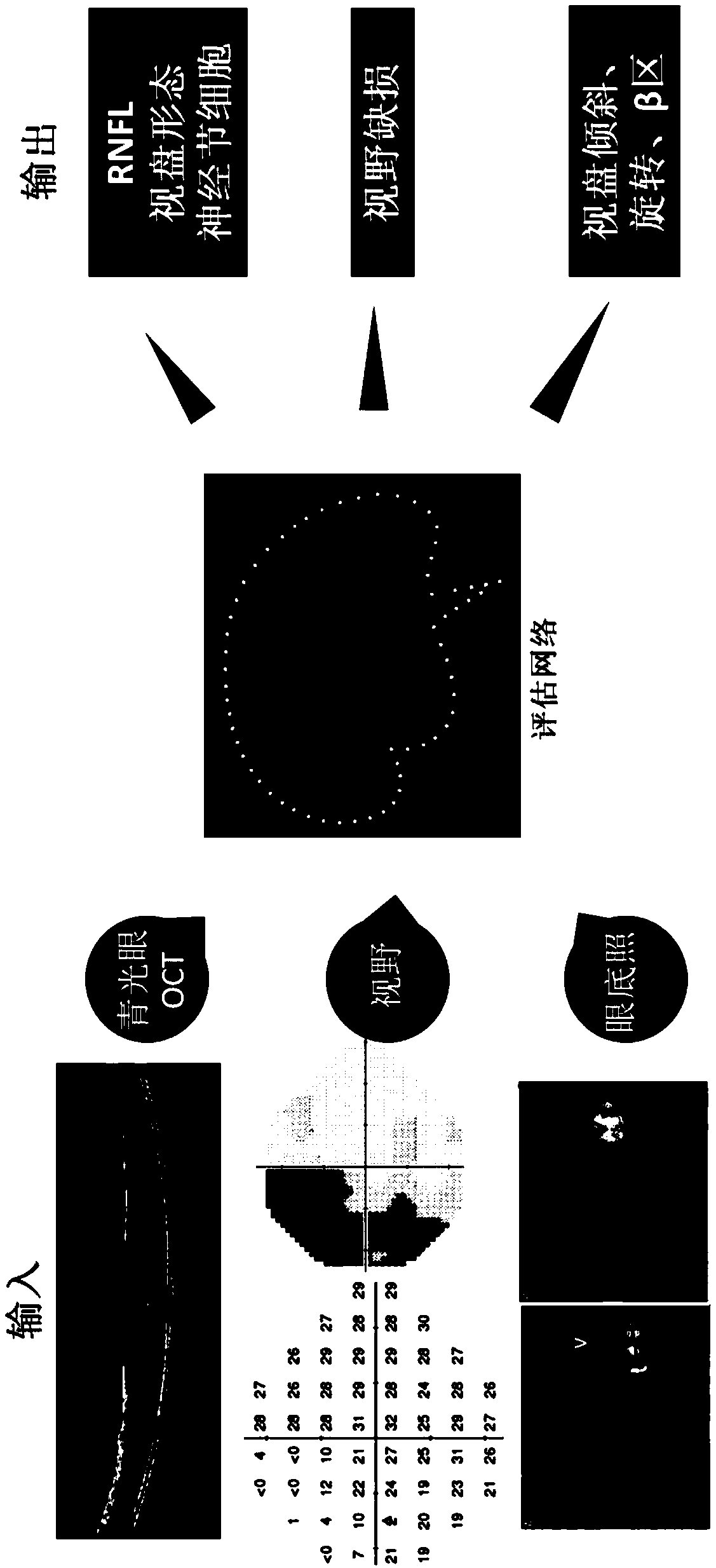 Intelligent screening system suitable for high myopia complicated by open angle glaucoma and establishment method thereof