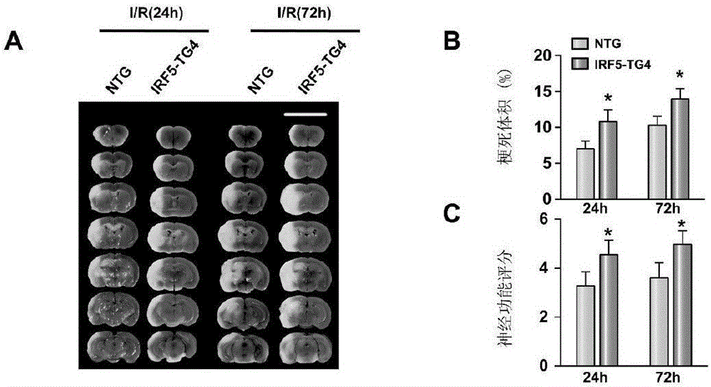 Application of interferon regulatory factor 5 and inhibitor thereof to cerebral stroke diseases