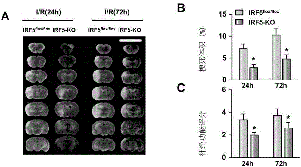 Application of interferon regulatory factor 5 and inhibitor thereof to cerebral stroke diseases