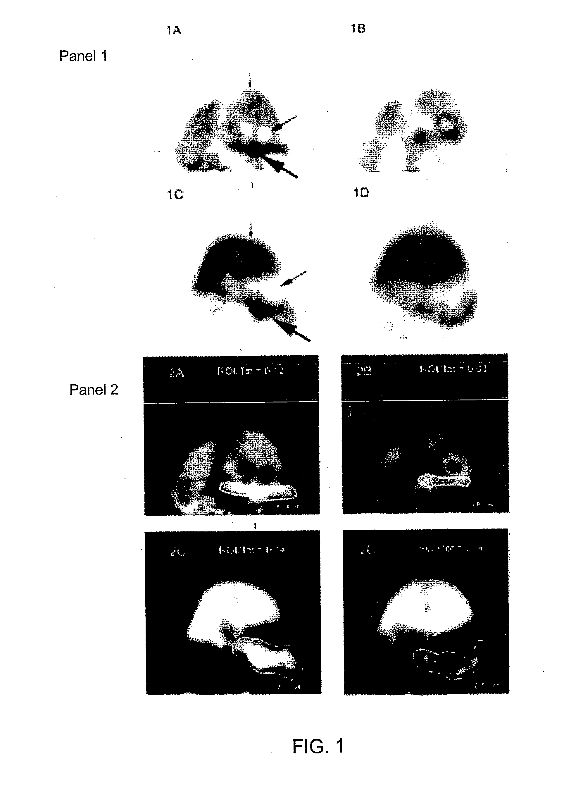 Use of Dtbz for Imaging Endocrine Pancreas and Beta Cell Mass In Type 1 Diabetes