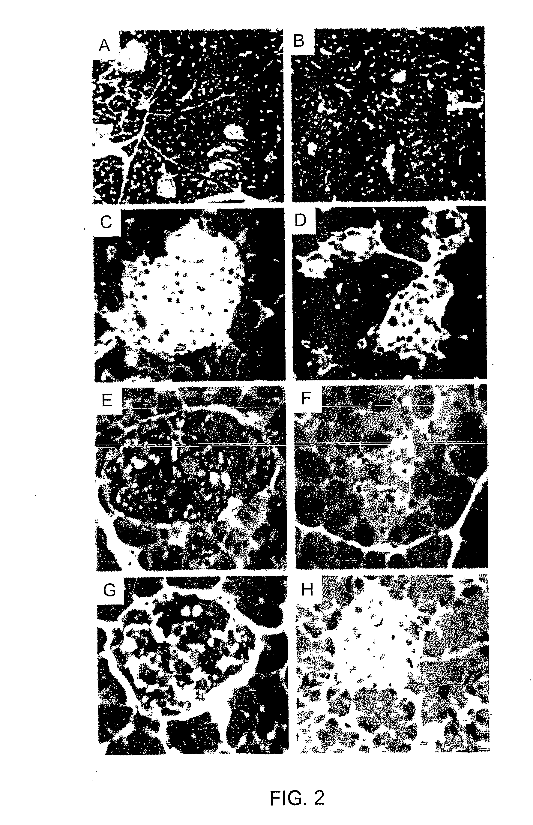 Use of Dtbz for Imaging Endocrine Pancreas and Beta Cell Mass In Type 1 Diabetes