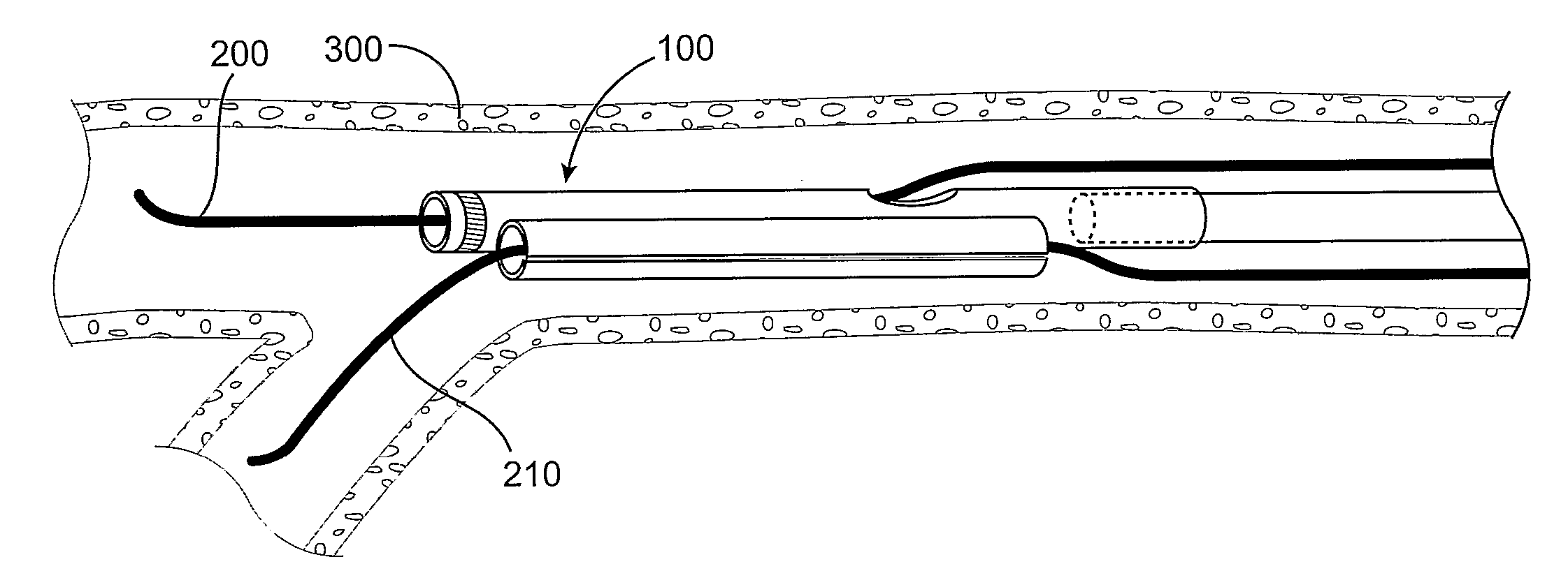 Guidewire Separator Device and Method of Use