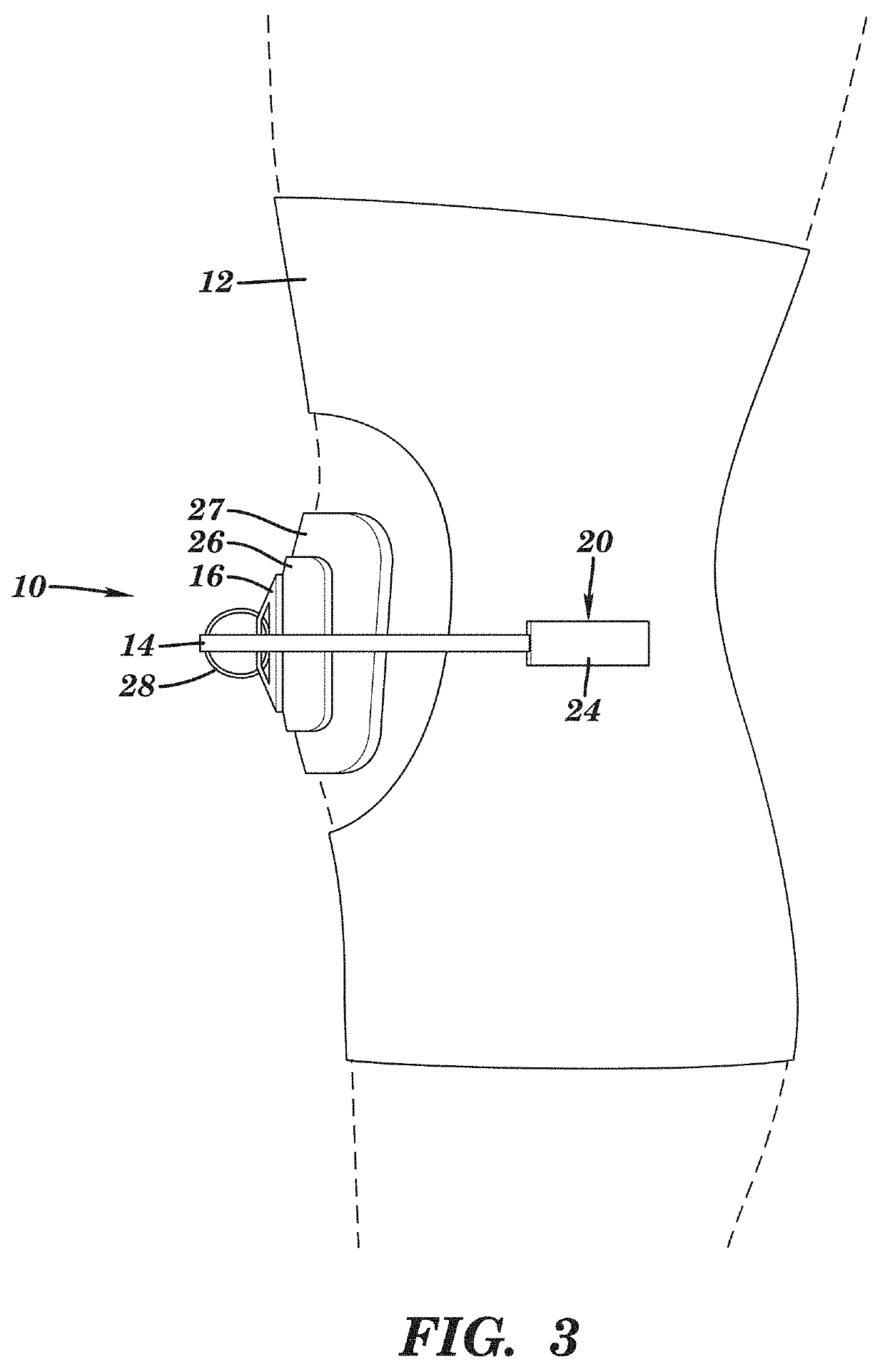 Device for managing patellofemoral pain and methods of use thereof