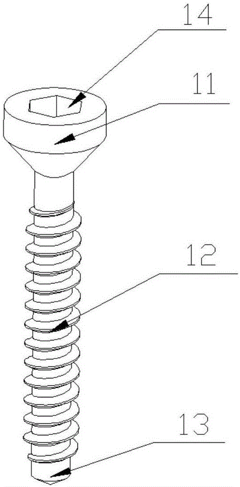 Bone screw covered with soft material