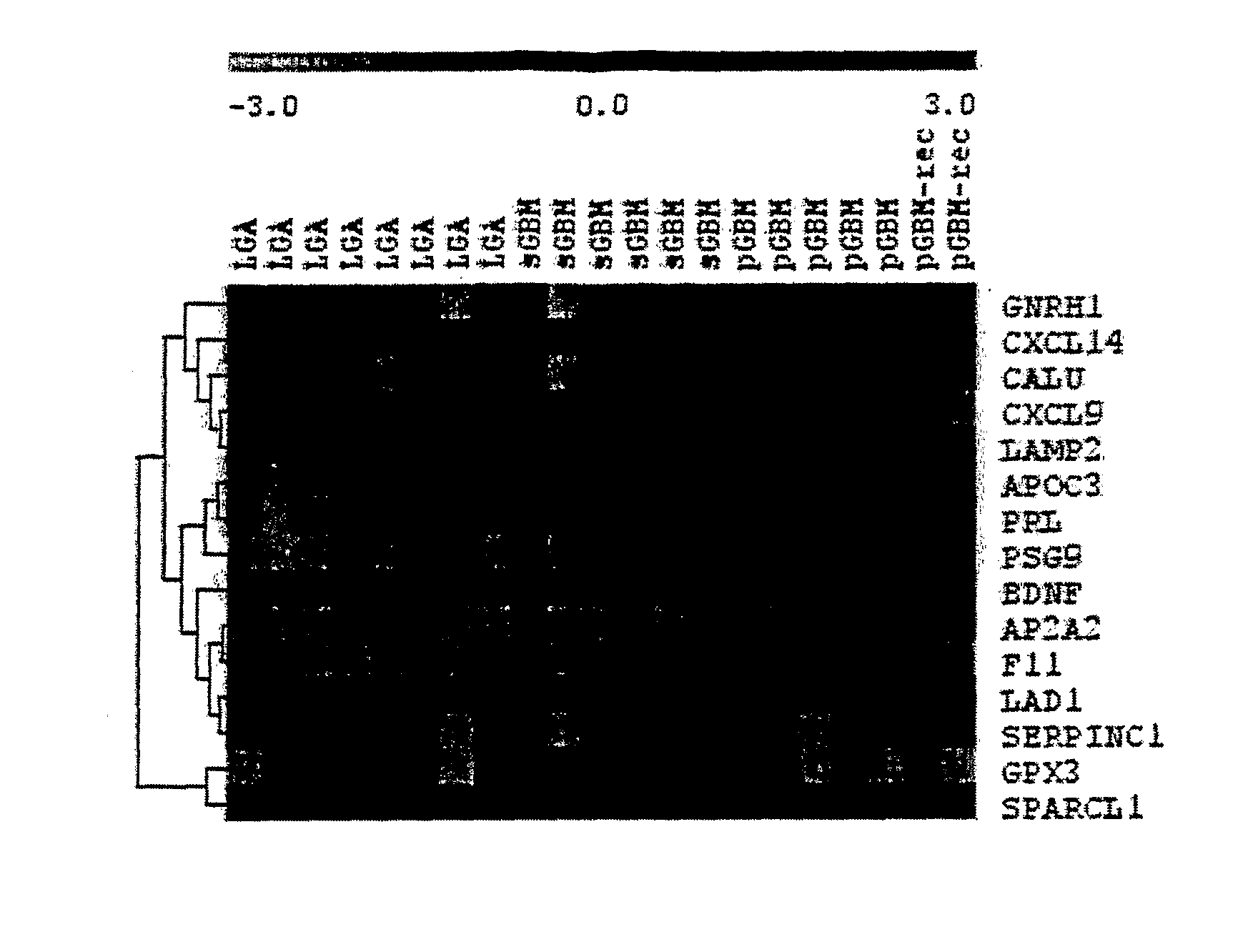 Method for the Diagnosis of Higher- and Lower-Grade Astrocytoma Using Biomarkers and Diagnostic Kit Thereof