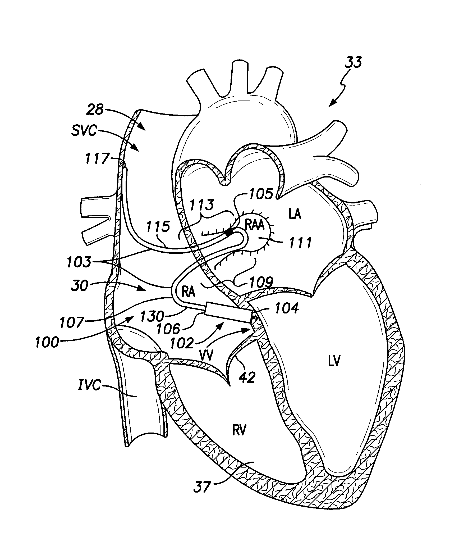 Leadless intra-cardiac medical device with reduced number of feed-thrus