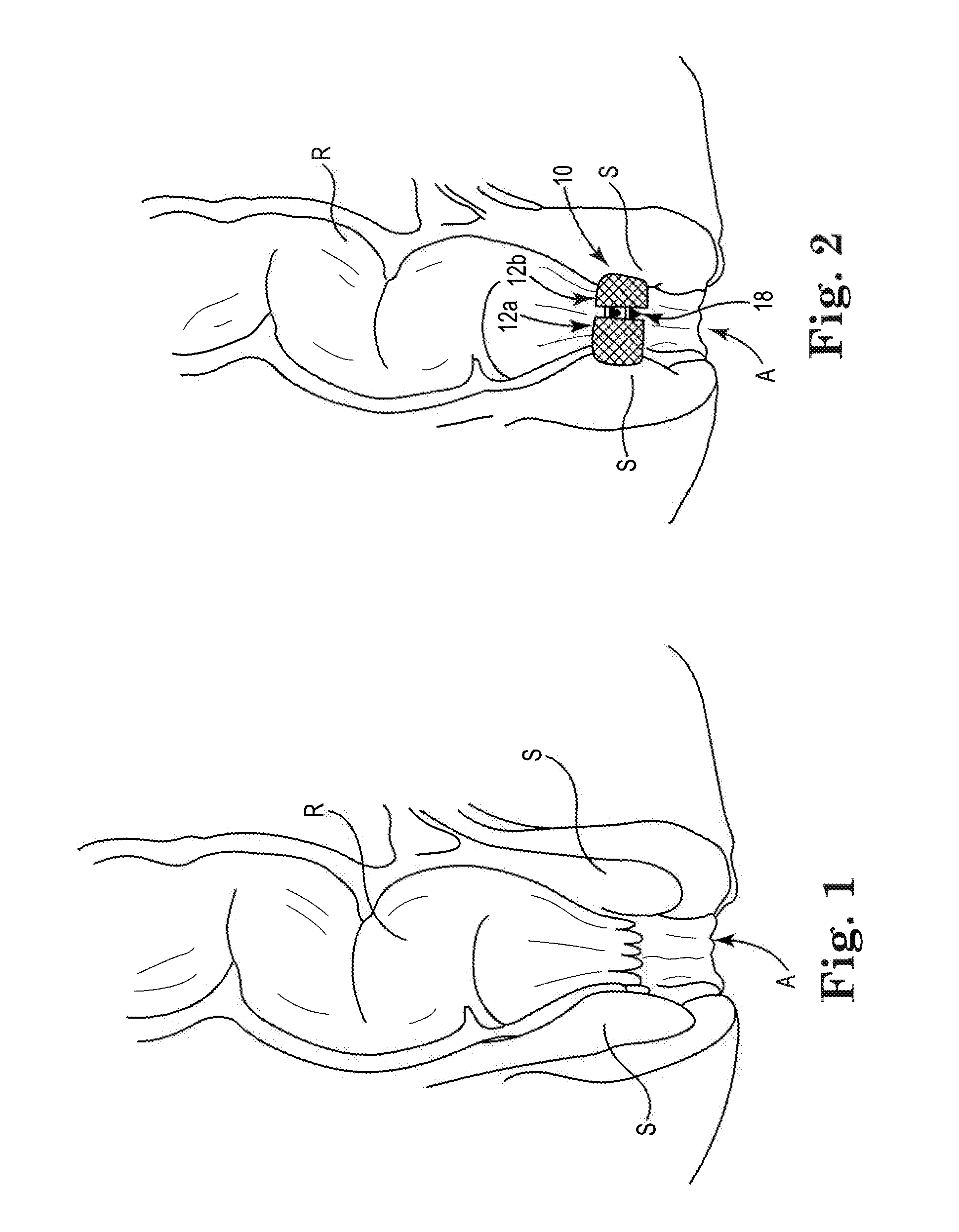 Fecal Incontinence Treatment Device and Method