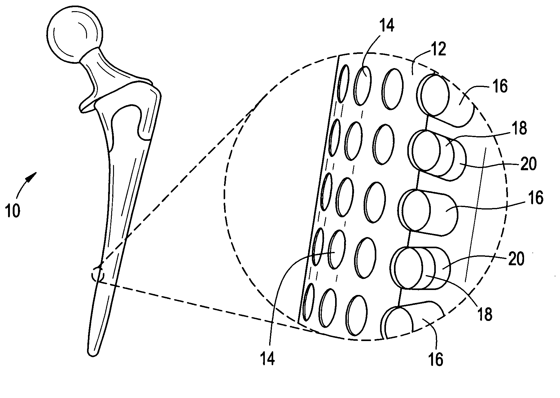 Orthopedic and dental implant devices providing controlled drug delivery