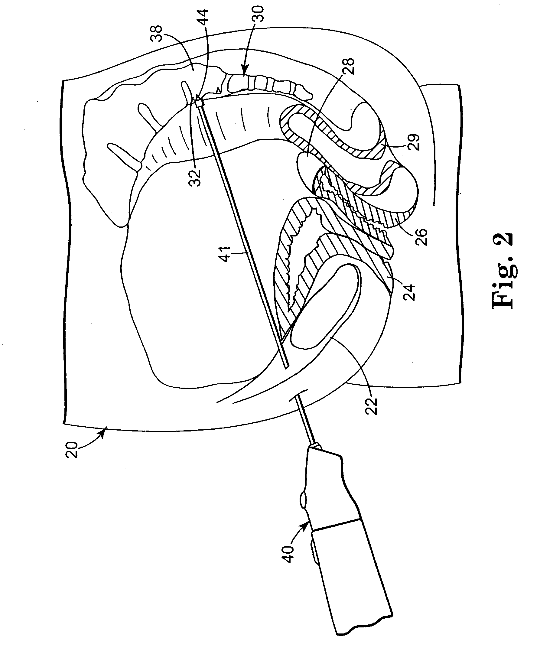 Implantable article and method