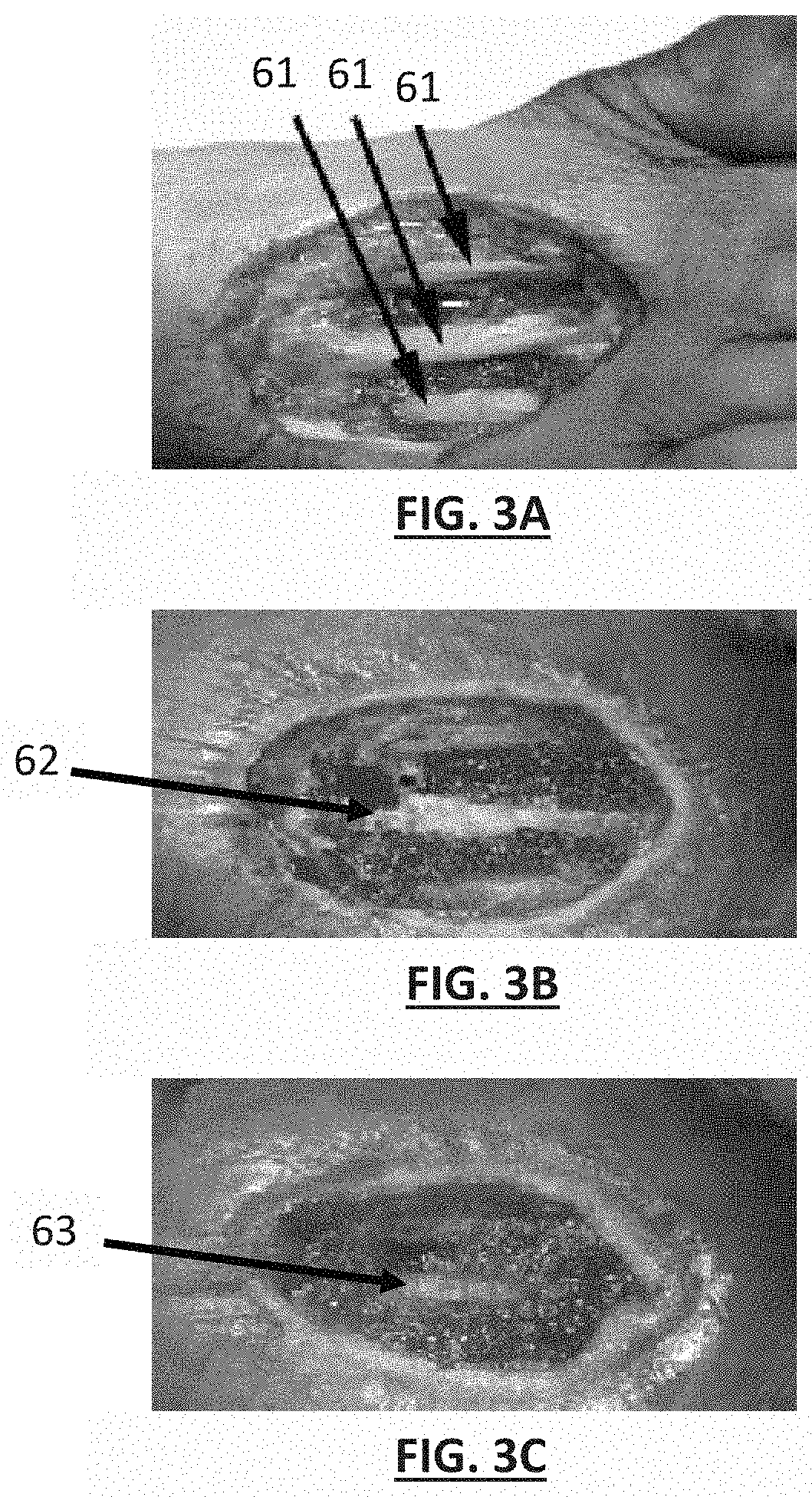 Negative Pressure Wound Therapy for Treatment of Periodontal Disease