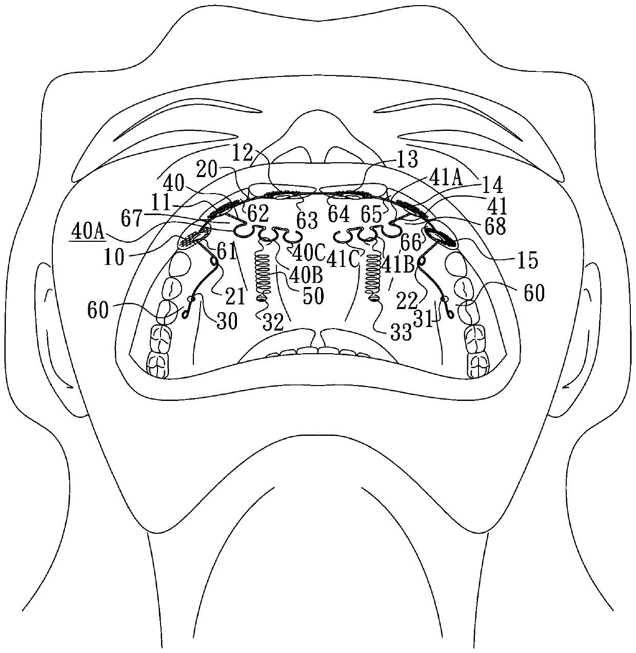 Lingual anterior teeth retractor