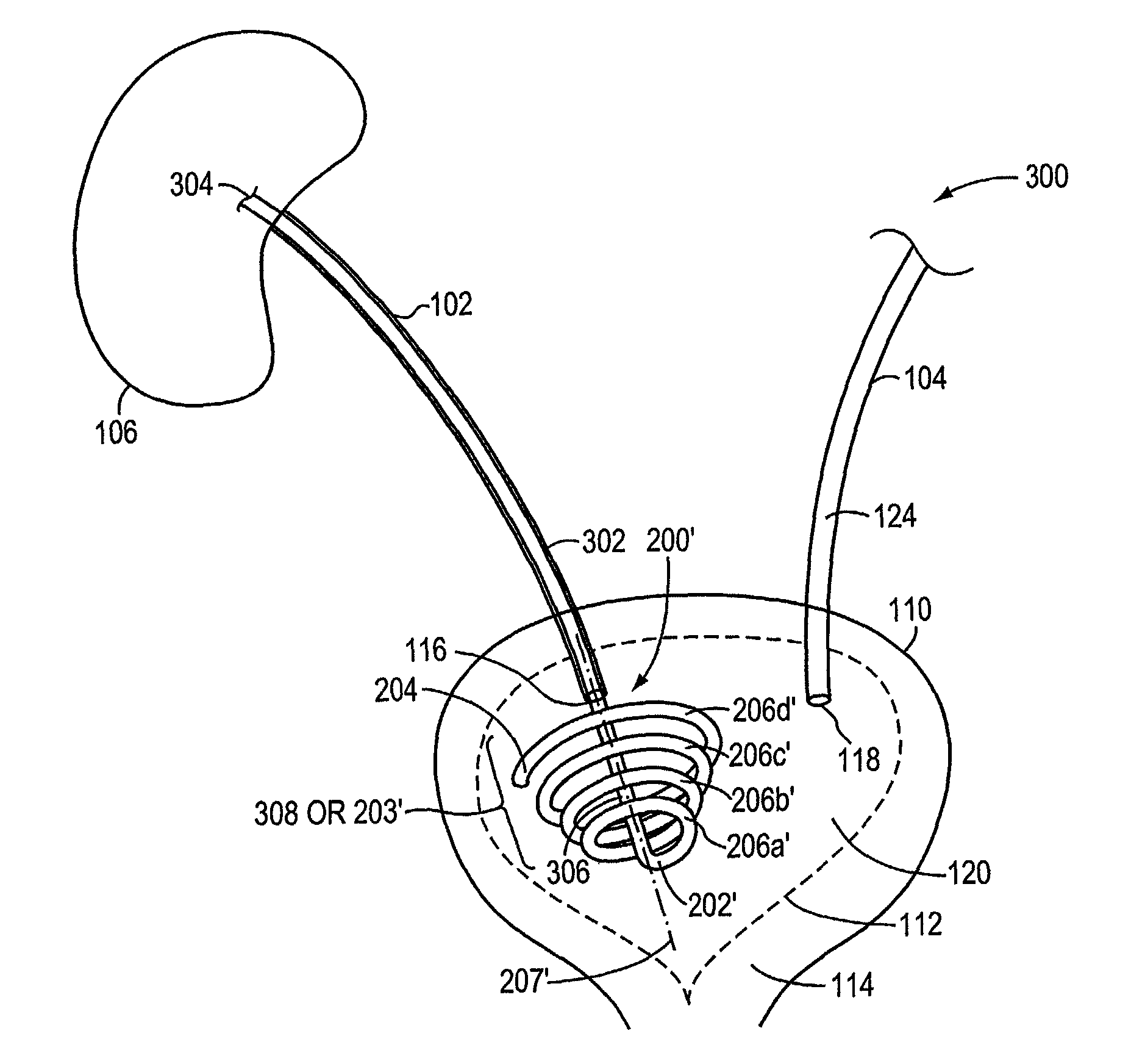 Stent retention element and related methods