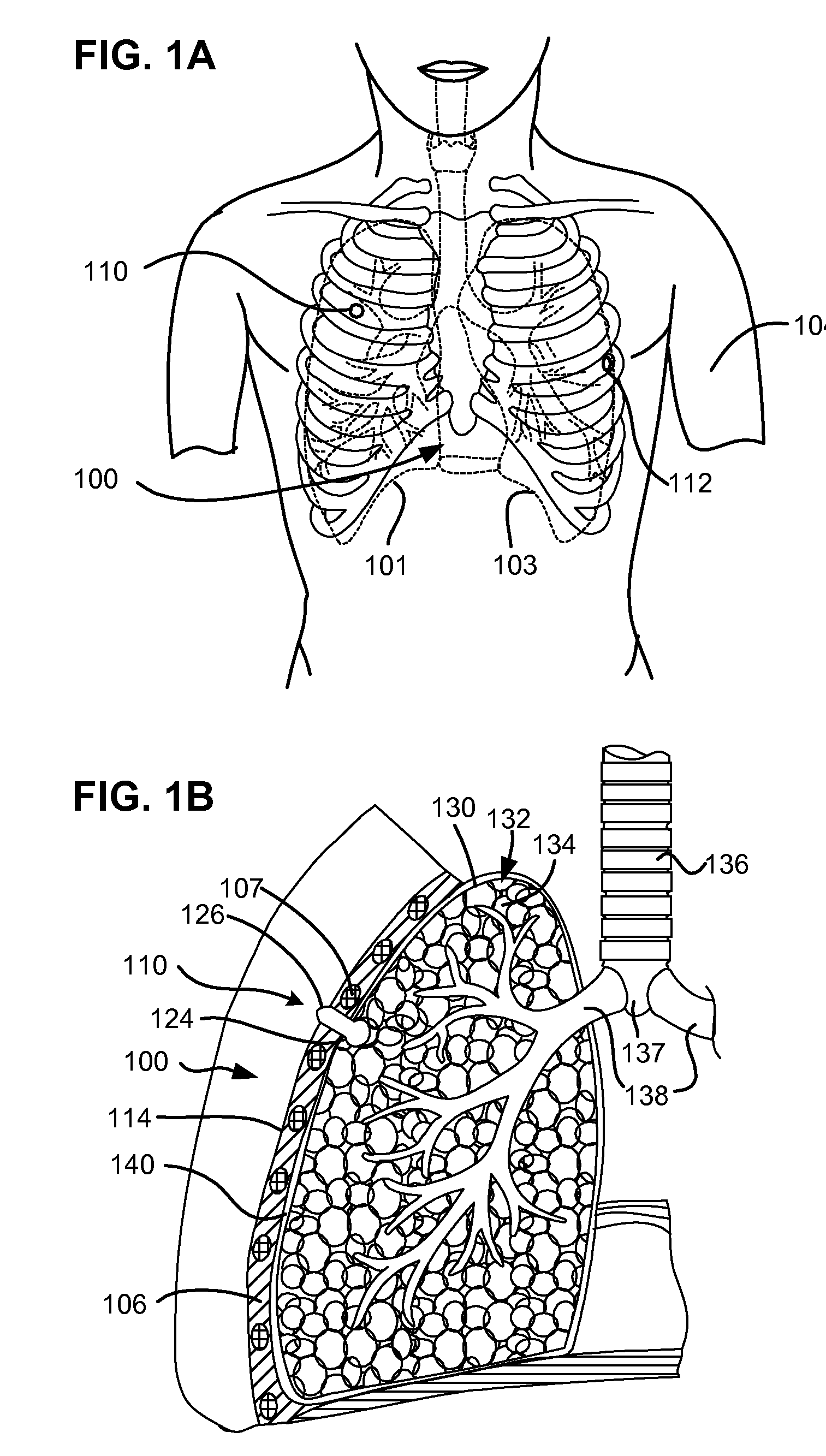Multi-layer pneumostoma management system and methods for treatment of chronic obstructive pulmonary disease
