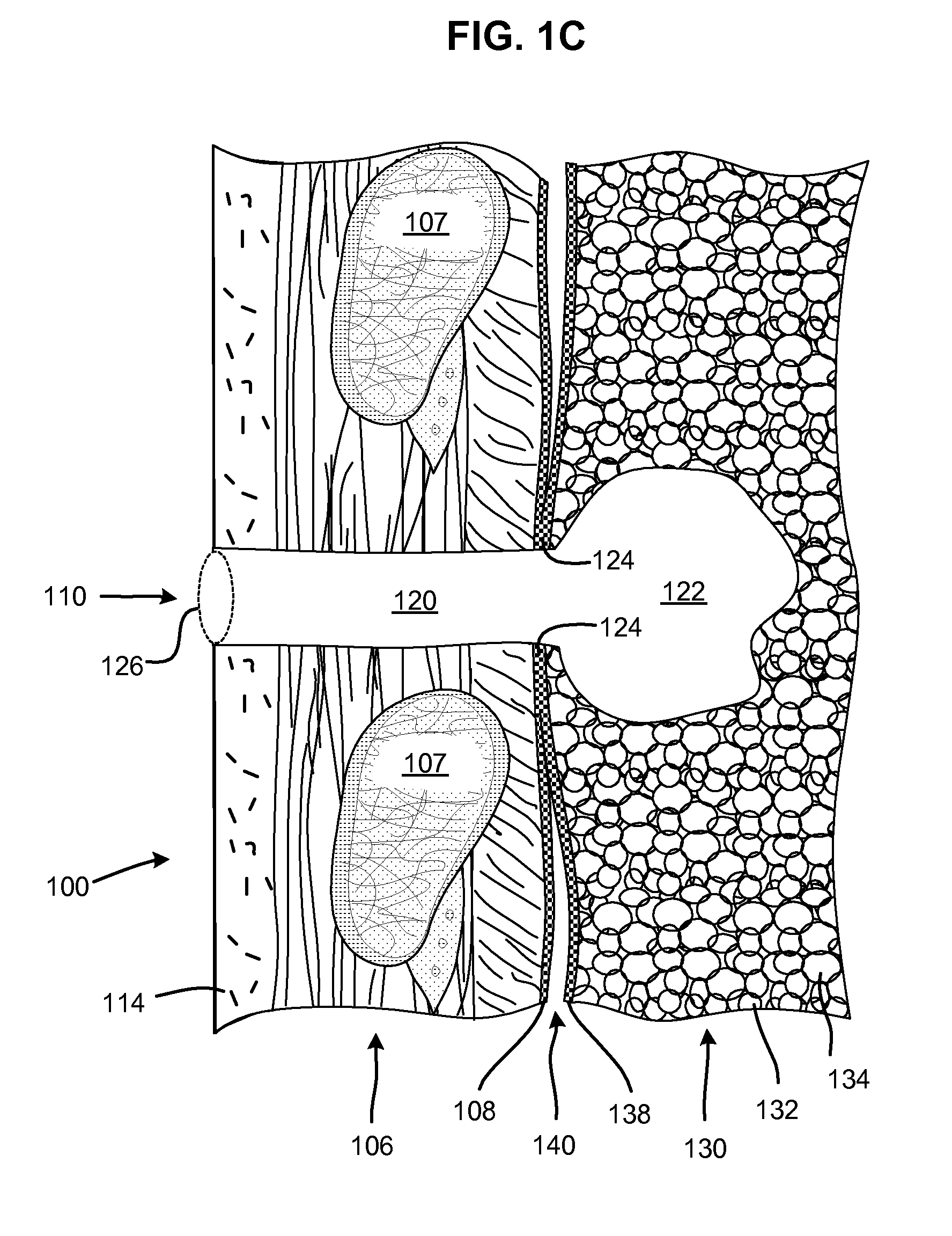Multi-layer pneumostoma management system and methods for treatment of chronic obstructive pulmonary disease