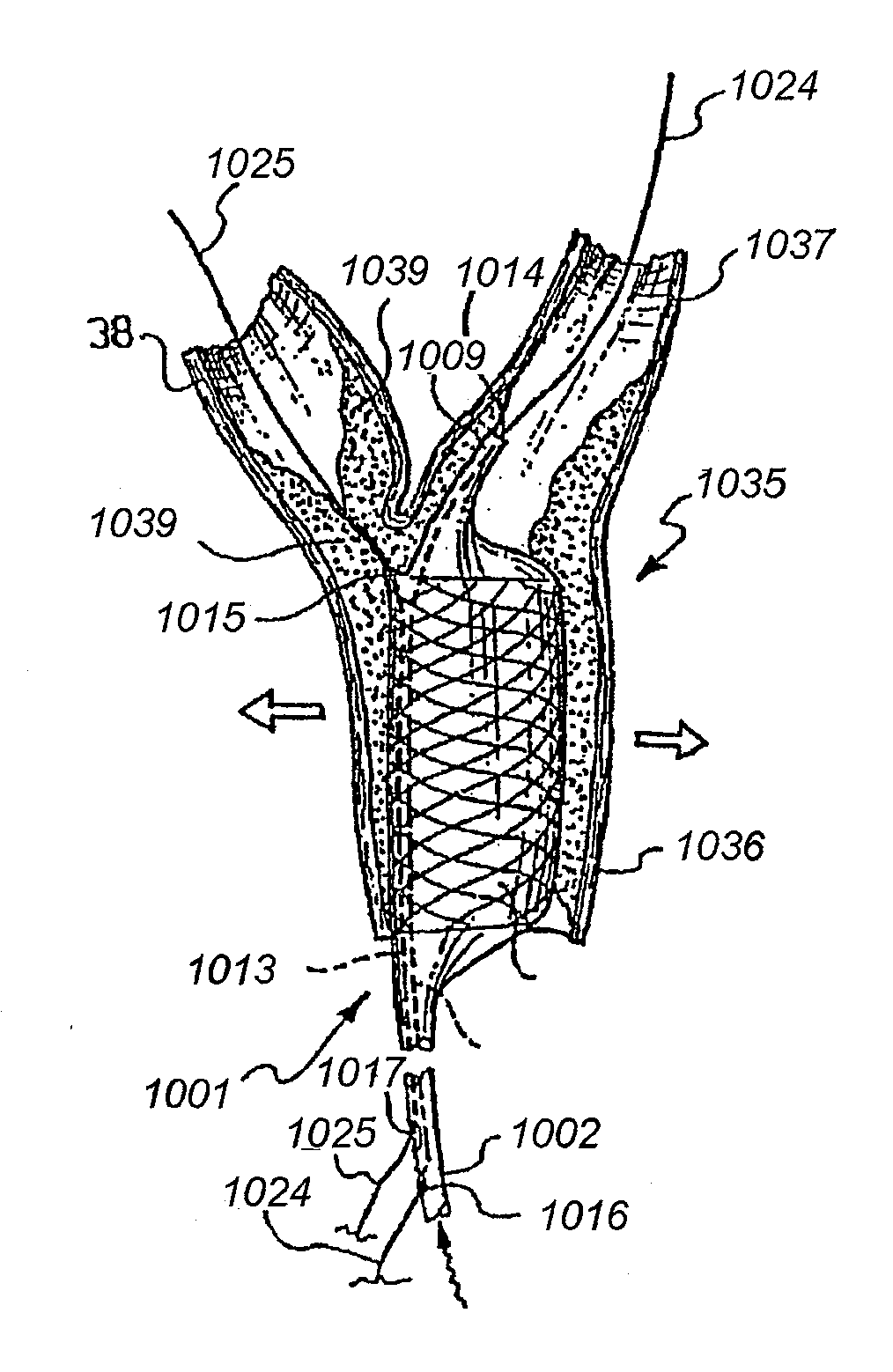 Microcatheter