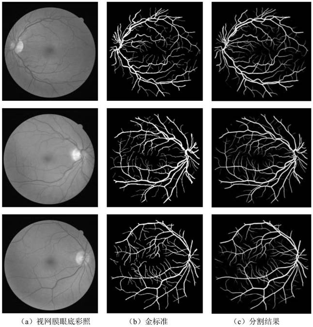 Retinal fundus vessel segmentation method based on deep multi-scale attention convolutional neural network