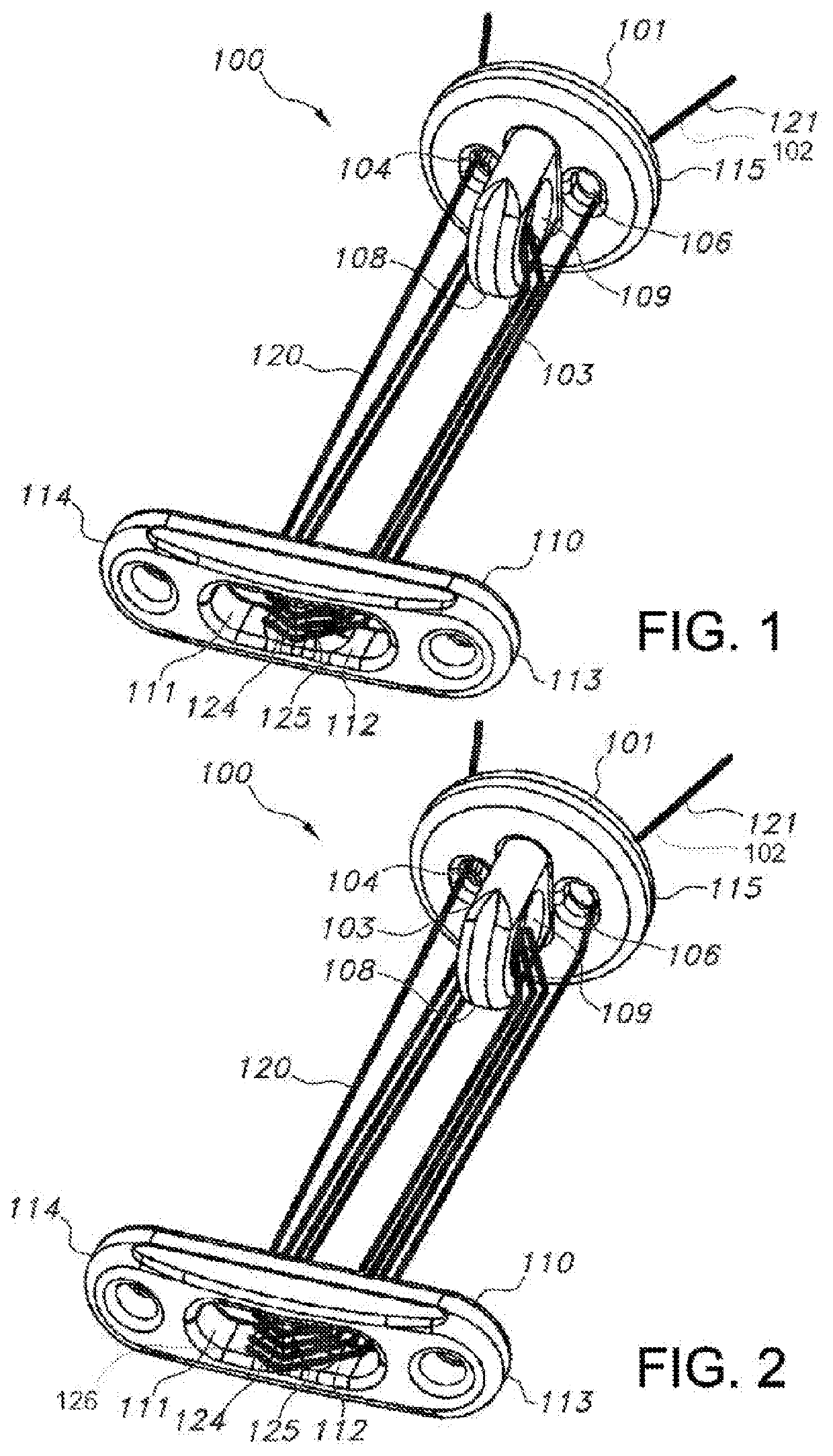 Knotless orthopedic stabilization system