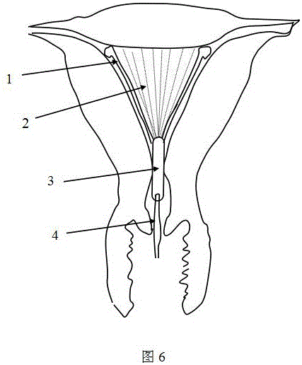 Anti-intrauterine adhesion device