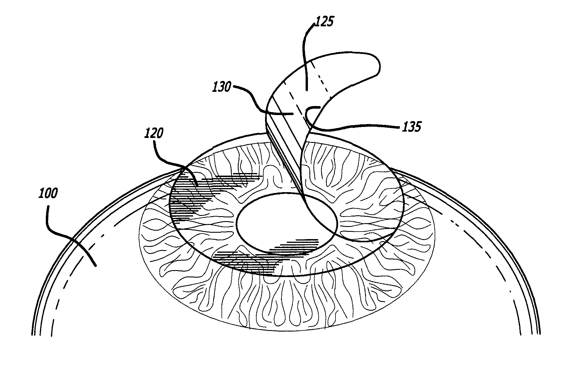 Method of correcting vision problems using only a photodisruption laser