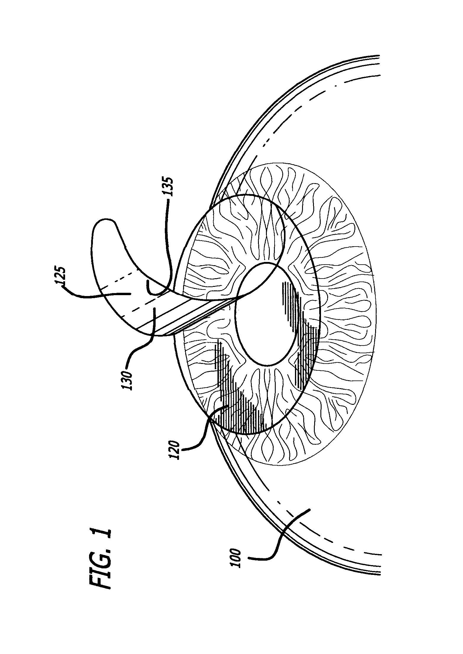 Method of correcting vision problems using only a photodisruption laser