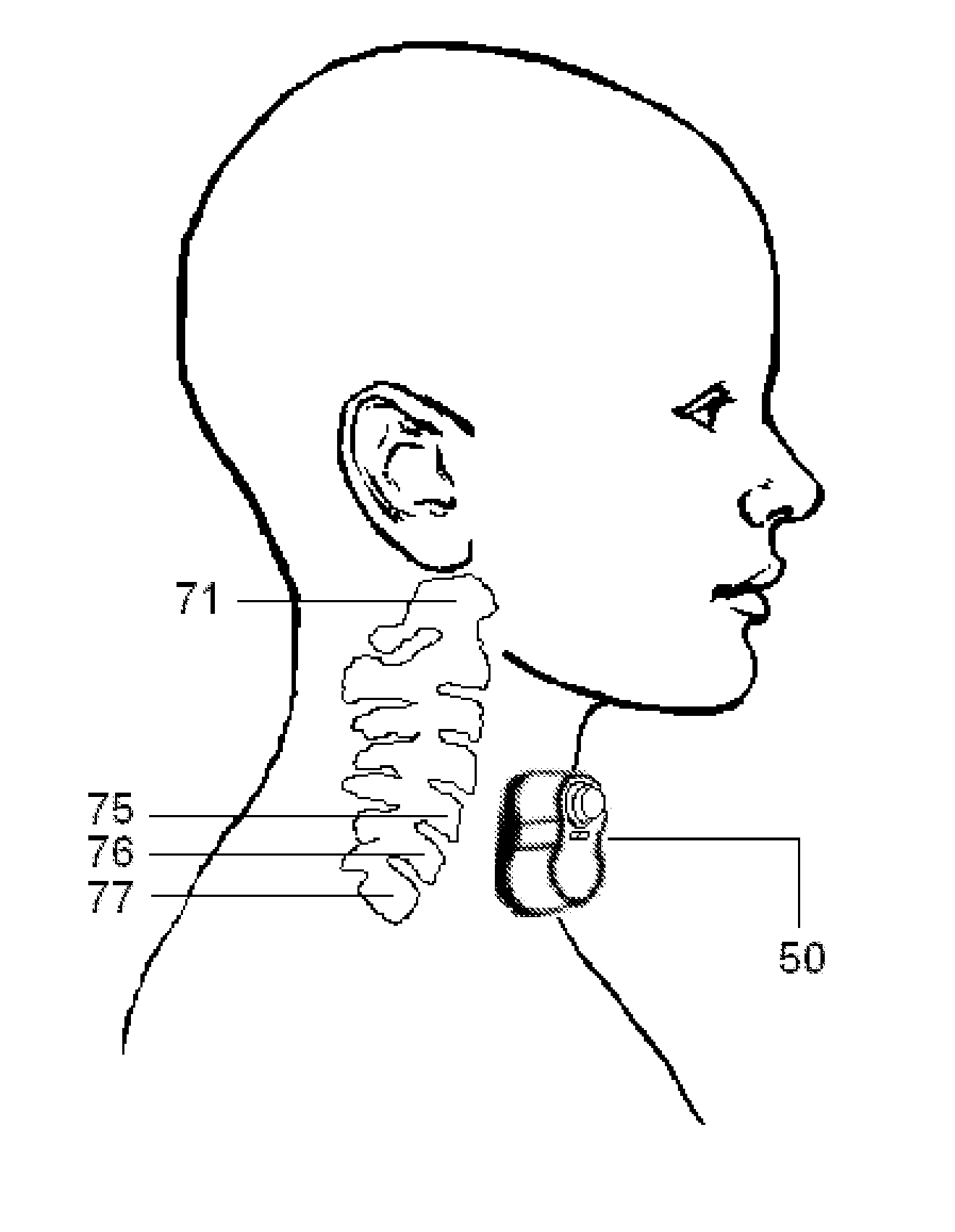 Nerve stimulation methods for averting imminent onset or episode of a disease