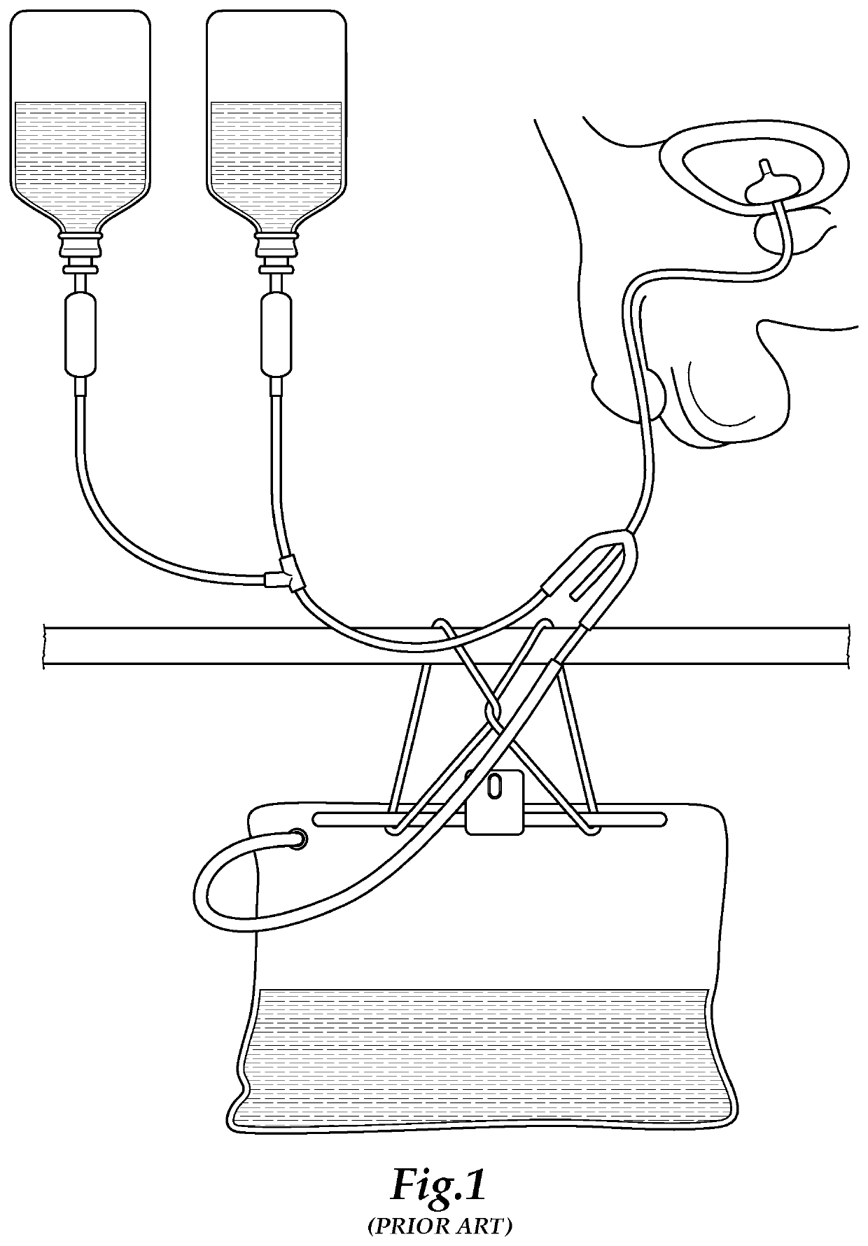 Bladder irrigation tool