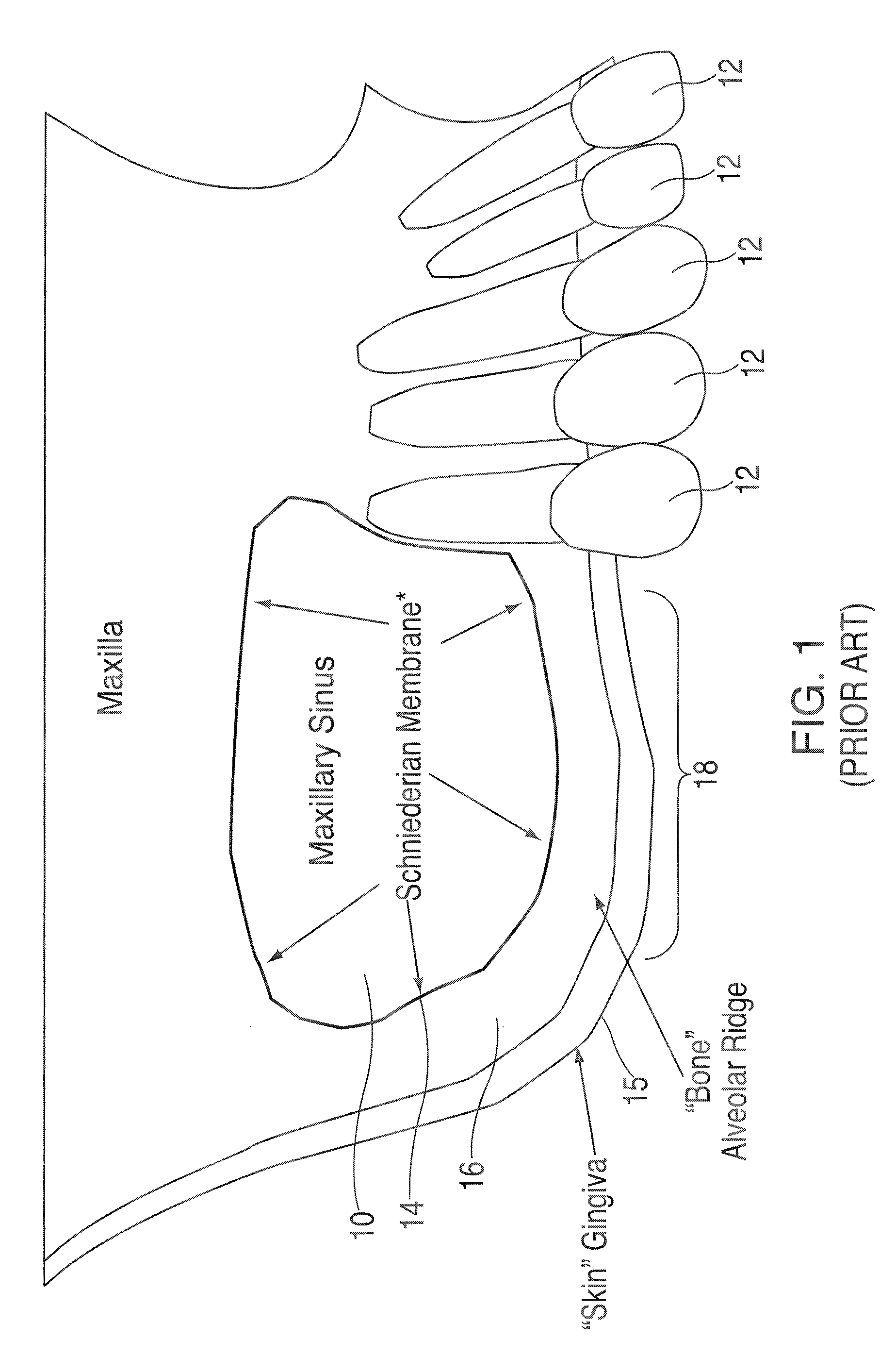 Method and apparatus for performing maxillary sinus elevation