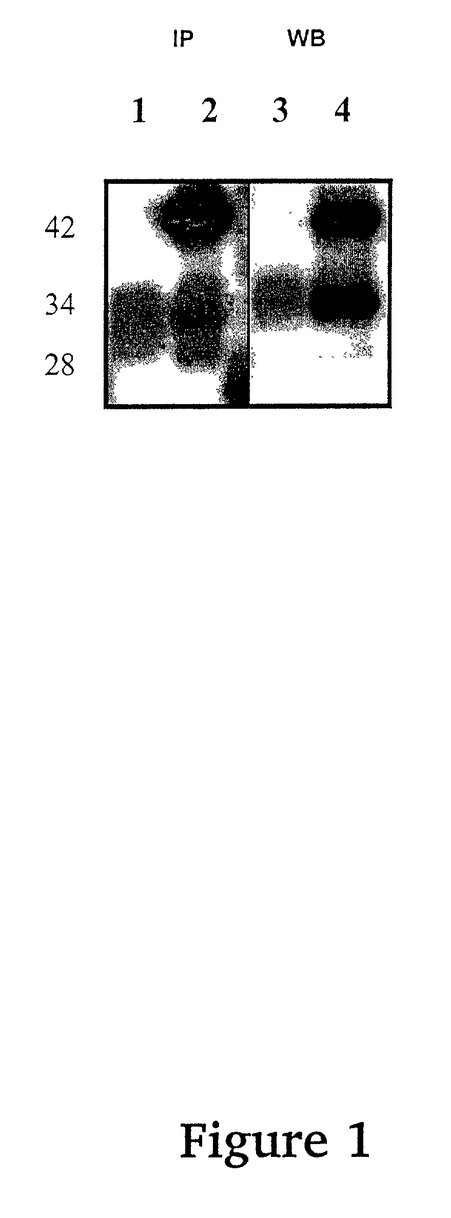 Method for diagnosing a pre-neoplastic or neoplastic lesion in transitional epithelial cells