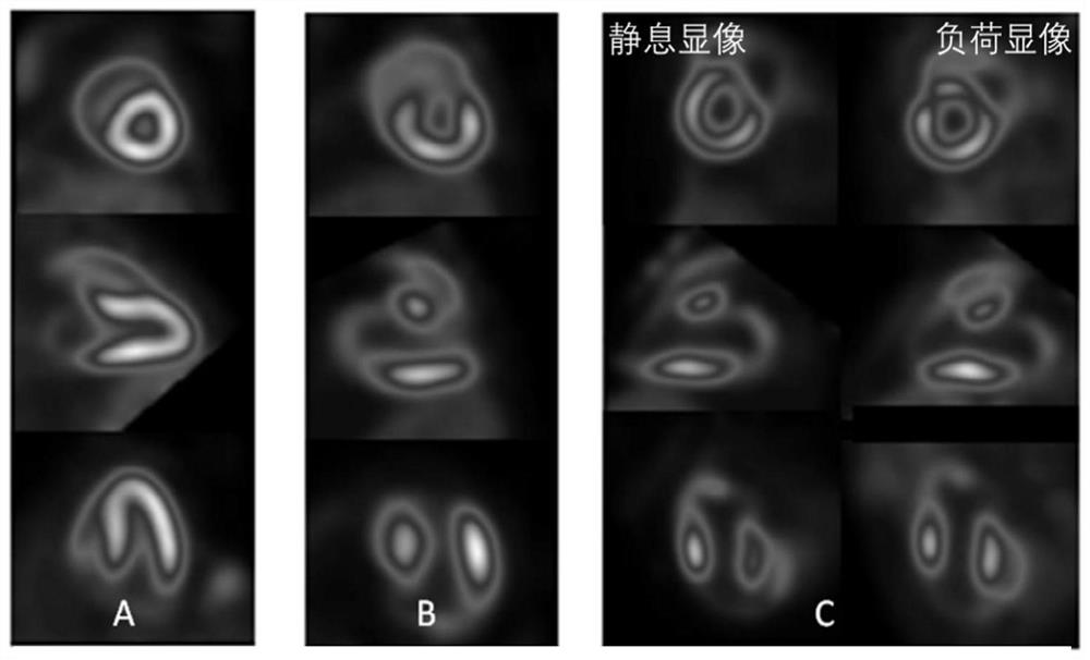 A kind of preparation method and application of pyridazinone myocardial perfusion PET radiopharmaceutical