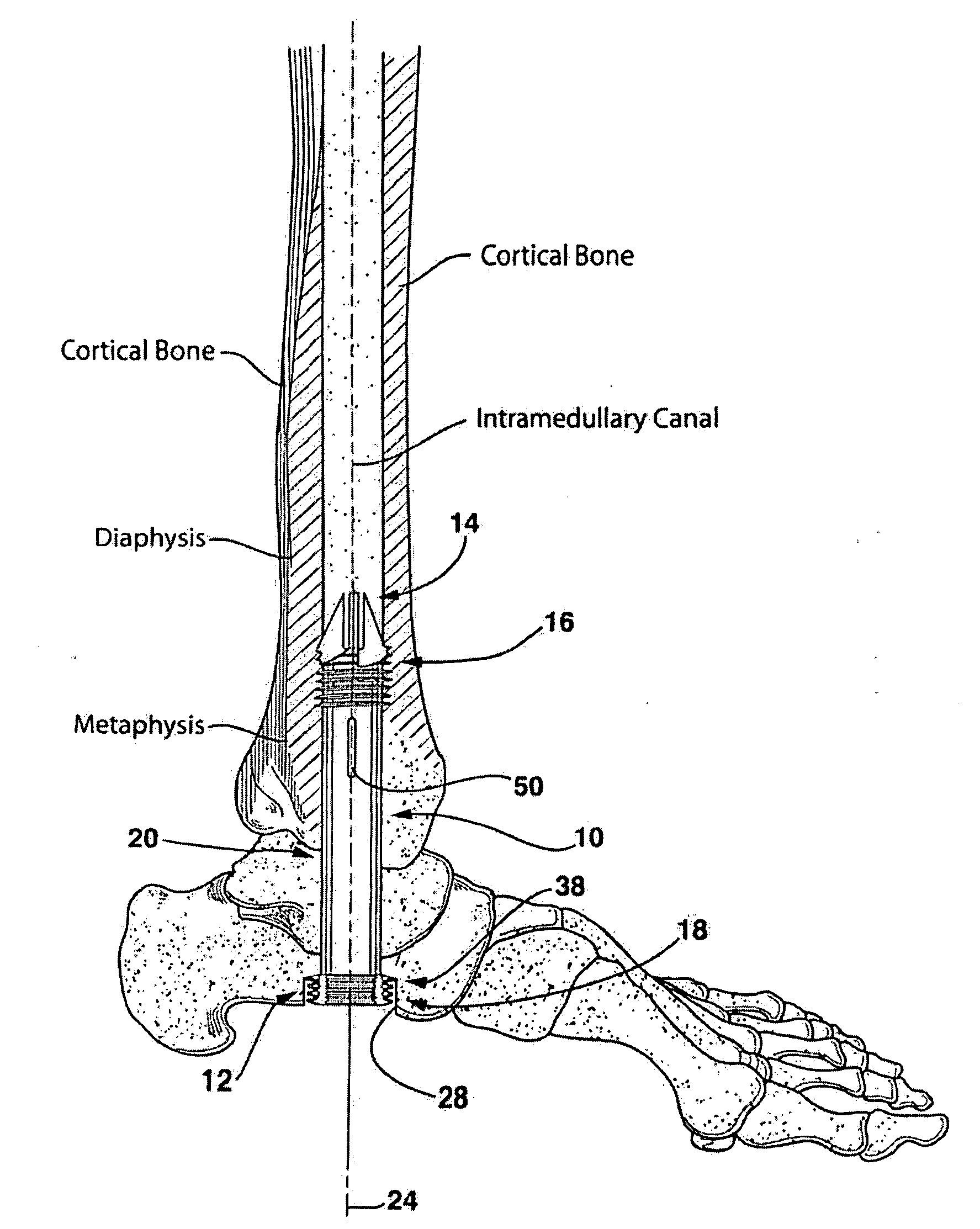 Intramedullary locked compression screw for stabilization and union of complex ankle and subtalar deformities