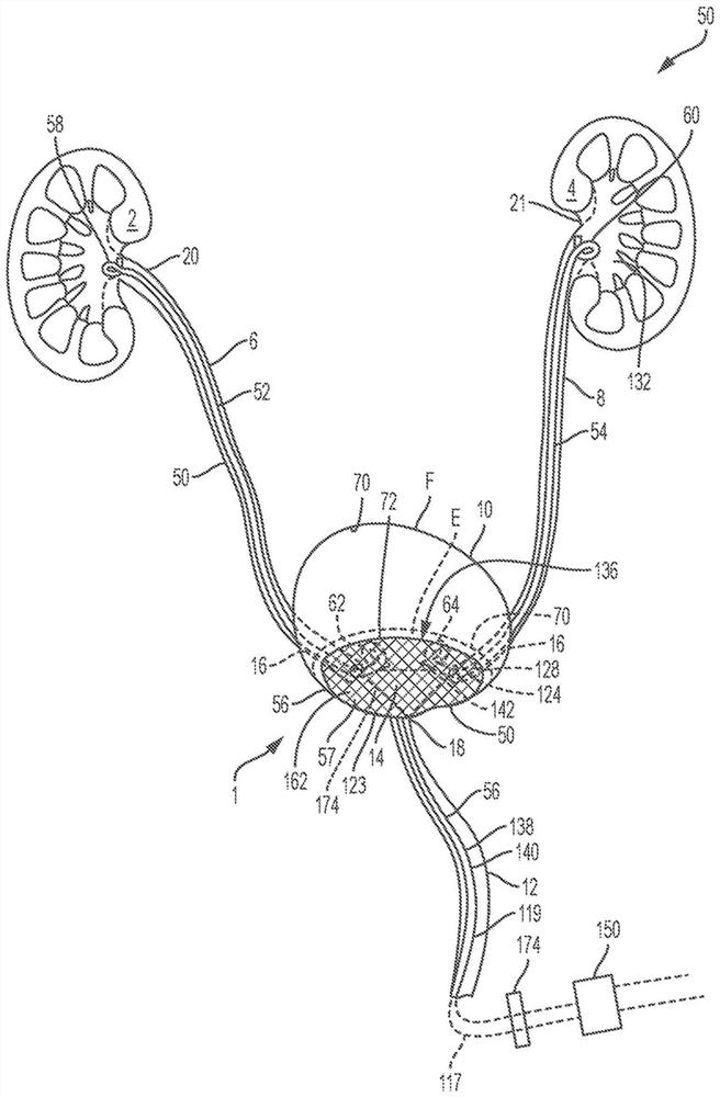 Coated and/or impregnated ureteral catheter or stent and manufacturing method thereof
