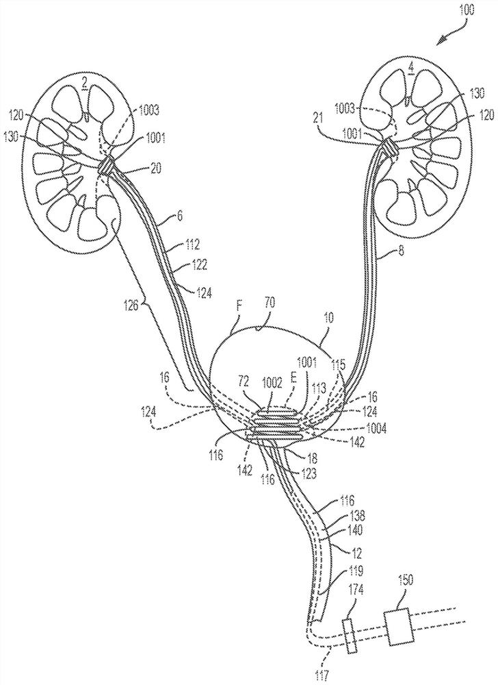 Coated and/or impregnated ureteral catheter or stent and manufacturing method thereof